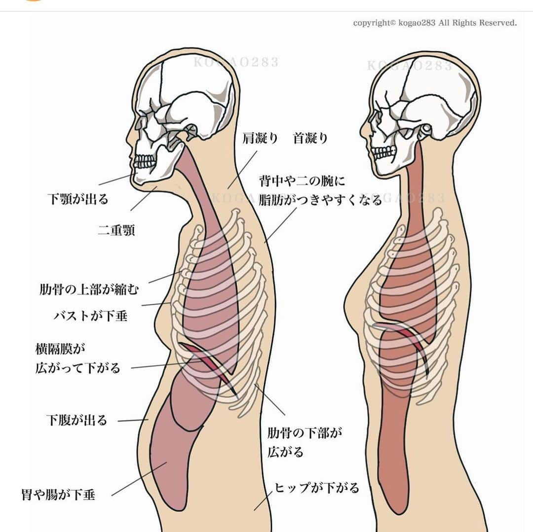 kogao283さんのインスタグラム写真 - (kogao283Instagram)「貴方の姿勢は大丈夫ですか？  「猫背姿勢でいると横隔膜がしっかりと使えない」  猫背姿勢で長時間デスクワークをしていると胸部・腹部が圧迫される為　大きく空気を吸い込む事が出来なくなります。  すると　本来呼吸をする度に動いていたはずの「肋骨」をあまり動かさなくなります。 その状態で浅い呼吸をするので筋肉（肋間筋）はどんどん硬くなります。  すると　デスクワークから開放されても猫背の姿勢が保持された状態になってしまいます。 これが「慢性的な猫背」になります。  猫背を予防するには ・「大きな呼吸をする事によって横隔膜を使い　 肋骨を動かす（＝肋間筋の伸張・収縮）事により　 筋肉を硬くさせない」事が大事です。   重力は骨や筋肉を強化してくれ、﻿ “立つ”“歩く”といった基本的動作を﻿ 行うためにも欠かせないものですが﻿ 2足歩行になった私たちの肌や筋肉は、﻿ 年齢の変化により 重力によって垂れていきやすくなります ﻿ ﻿ そして、二足歩行になったことで脳が大きくなり、﻿ 背骨にも重力がかかるようになったため、﻿ 猫背にもなりやすく😣﻿ ﻿ すると、姿勢が前かがみになるのでバストが垂れ、﻿ おしりが下がりやすくなってします ﻿ また姿勢の悪さで血液循環など 循環器系にも支障が出るためお顔も浮腫みやすくなります」1月17日 11時33分 - kogao283