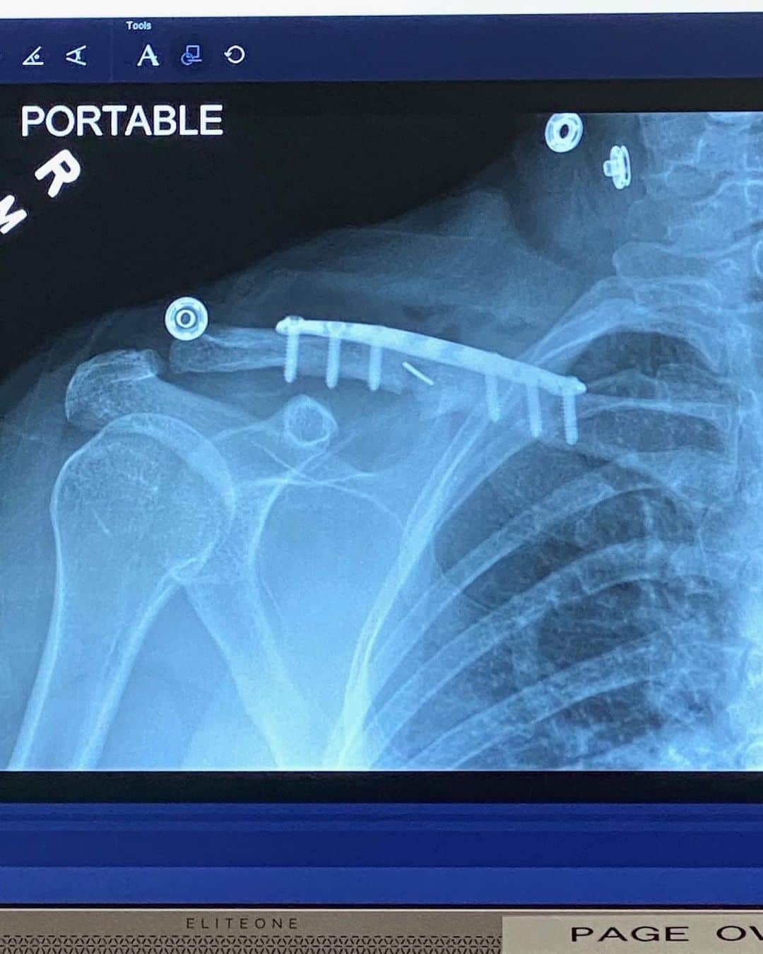ケン・ブロックのインスタグラム：「My wife had a gnarly snowboard crash recently and broke her collarbone. So now, she’s now got some lovely new titanium jewelry holding her together! She’s recovering well and will be back on her board in 6-8 weeks. #toughlady」