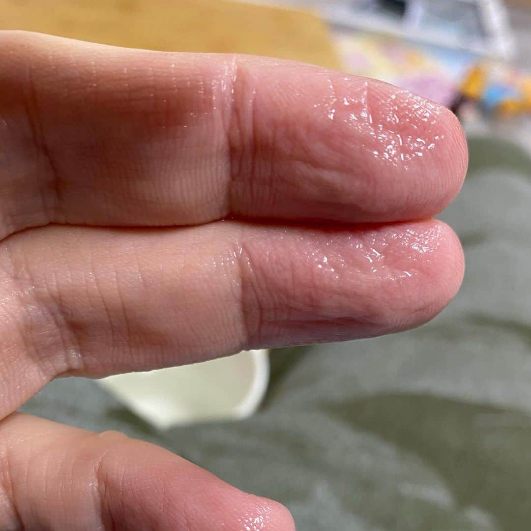 326のインスタグラム：「ボーッとしてて 火にかけたままのフライパン 間違って素手で持っちゃった… 大火傷… 流水で冷やしてはいますけどどうなることやら 左手だったのがせめてもの救いかな 表皮がぶにゃぶにゃになっちまったよおおおおおお うおおおおん 最近こういうの本当多い…ハァ」