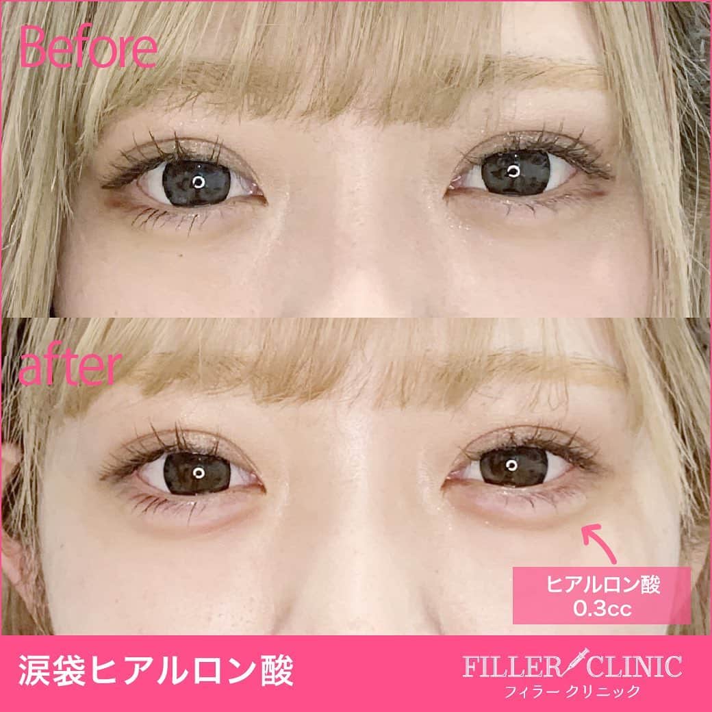 恵比寿フィラークリニックさんのインスタグラム写真 - (恵比寿フィラークリニックInstagram)「﻿ かわいい子はみんなやってる？！﻿ ﻿ ♡涙袋ヒアルロン酸♡﻿ フィラーで1位,2位を争う人気施術です🥰﻿ ﻿ 涙袋ヒアルロン酸のメリット﻿ ⇩⇩⇩﻿ 中顔面解消﻿ メイク時間短縮💄﻿ デカ目効果👀﻿ とにかくカワイイ！﻿ ﻿ マスクをしてても見える目元😷﻿ 涙袋があるだけでお顔の印象も華やかになります✨﻿ ﻿ 💴料金💴﻿ 0.1cc 3,000円(税抜)～﻿ ﻿ ⚠️リスクなど⚠️﻿ まれに内出血が起こる場合がありますが1～2週間ほどで落ち着きます。﻿ 術後に腫れが出る場合もありますが2～3日でおさまります。﻿ ﻿ ﻿ ﻿ #フィラークリニック #フィラー #プチ整形 #美容整形 #filler #ヒアルロン酸 #ボトックス #水光注射 #糸リフト #唇 #lip #鼻 #鼻筋 #目元 #マスクメイク特集 #マスクメイク #目 #ヒアルロン酸注射 #ヒアルロン酸注入 #メイク映え #かわいい #メイク時間短縮 #涙袋ヒアルロン酸 #涙袋 #涙袋メイク #メイク #面長カバー #面長 #中顔面短縮 #中顔面」1月18日 16時37分 - filler_clinic