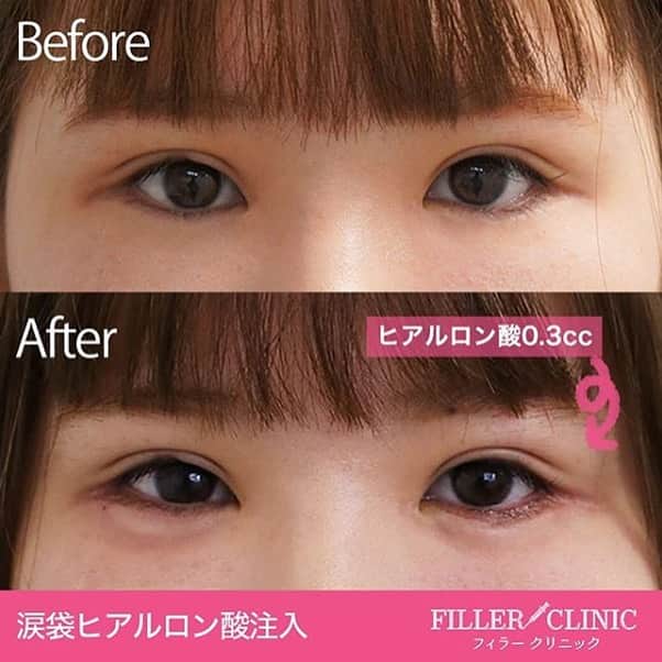 恵比寿フィラークリニックさんのインスタグラム写真 - (恵比寿フィラークリニックInstagram)「﻿ かわいい子はみんなやってる？！﻿ ﻿ ♡涙袋ヒアルロン酸♡﻿ フィラーで1位,2位を争う人気施術です🥰﻿ ﻿ 涙袋ヒアルロン酸のメリット﻿ ⇩⇩⇩﻿ 中顔面解消﻿ メイク時間短縮💄﻿ デカ目効果👀﻿ とにかくカワイイ！﻿ ﻿ マスクをしてても見える目元😷﻿ 涙袋があるだけでお顔の印象も華やかになります✨﻿ ﻿ 💴料金💴﻿ 0.1cc 3,000円(税抜)～﻿ ﻿ ⚠️リスクなど⚠️﻿ まれに内出血が起こる場合がありますが1～2週間ほどで落ち着きます。﻿ 術後に腫れが出る場合もありますが2～3日でおさまります。﻿ ﻿ ﻿ ﻿ #フィラークリニック #フィラー #プチ整形 #美容整形 #filler #ヒアルロン酸 #ボトックス #水光注射 #糸リフト #唇 #lip #鼻 #鼻筋 #目元 #マスクメイク特集 #マスクメイク #目 #ヒアルロン酸注射 #ヒアルロン酸注入 #メイク映え #かわいい #メイク時間短縮 #涙袋ヒアルロン酸 #涙袋 #涙袋メイク #メイク #面長カバー #面長 #中顔面短縮 #中顔面」1月18日 16時37分 - filler_clinic