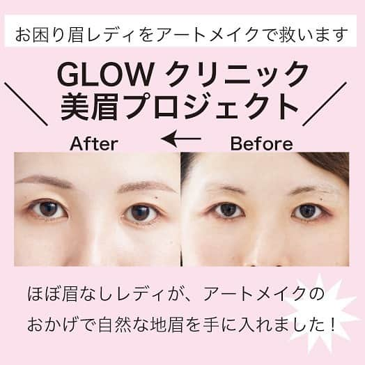 美人百花さんのインスタグラム写真 - (美人百花Instagram)「「GLOWクリニックの美眉プロジェクト」第２回は、ほぼ眉なしレディが登場‼️ 「若いころに眉毛を抜きすぎて、今はすっかり生えてこなくなってしまった😱」とお悩みのモニター高野さん👀 そんな高野さんが今回、GLOWクリニックで体験したのは３Gブロウズという施術✨１本１本毛流れを描き彫り、パウダー状に色を入れることでグラデーションが生まれ、自然で立体感のある美しい眉になるんです🌷🌷🌷  「眉がないことがコンプレックスで、眉メイクしても消えてるんじゃと、日々ビクビクしていました。地眉ができたことで、眉にかけていた時間もお金も浮いて、さらに自信もできて人生変わりました💕」と高野さんも大感動😭😭😭 詳しい全貌は、発売中の美人百花2月号をチェックしてね👍🏻👍🏻  #美人百花#GLOWクリニック#美眉#眉なし#アートメイク眉」1月20日 18時28分 - bijinhyakka