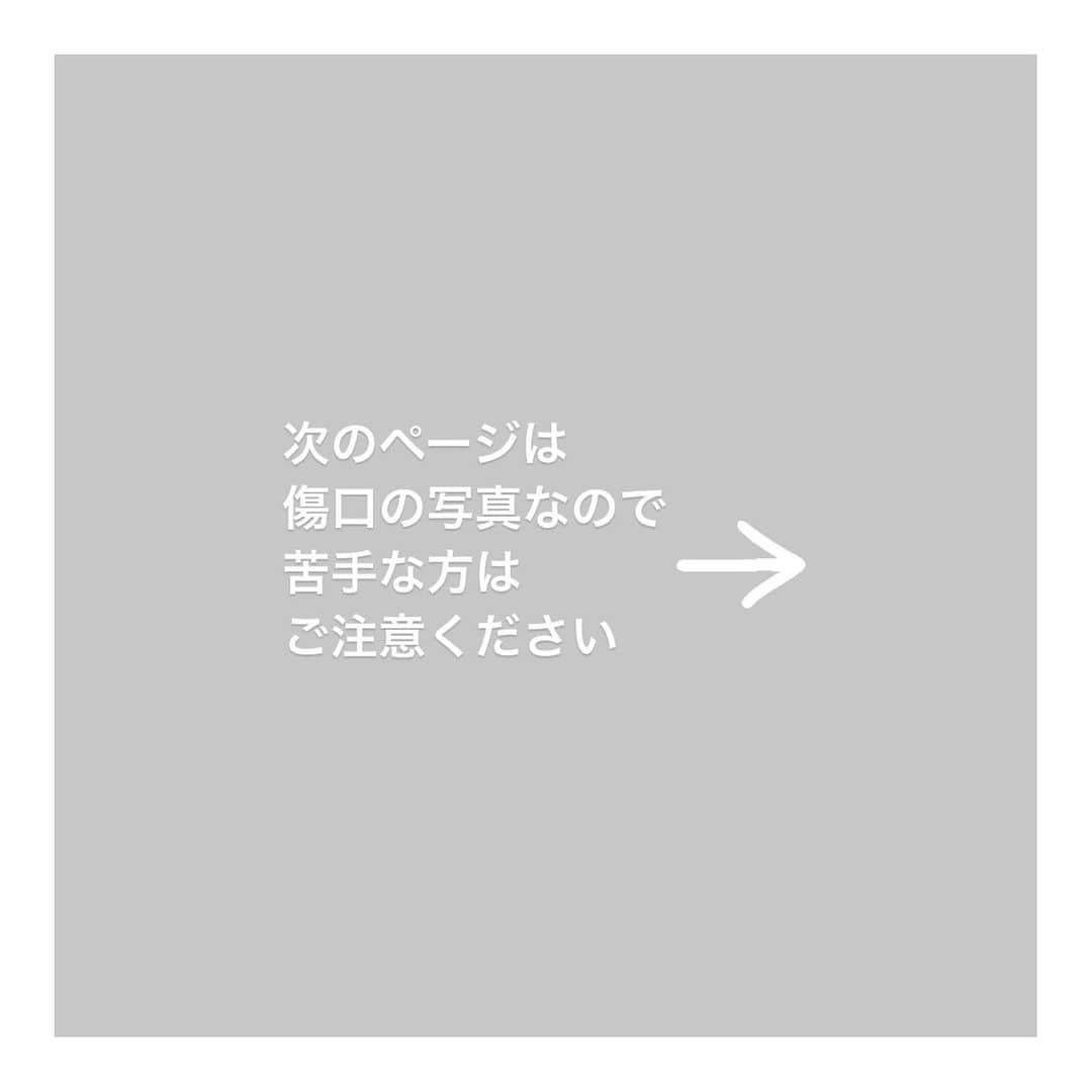 こむぎさんのインスタグラム写真 - (こむぎInstagram)「* ししくんのことです😭💦 (5枚目の写真は傷口なので苦手な方はスワイプご注意ください🙇🏻)  崩壊現場を脱出したししくん。ストーリーには先日体調不良と載せておりましたが、実は昨日入院になりました💦  ししくんは12月中旬から群馬の預かりさんのお家でお世話スタートして、順調にカリカリも食べて慣れてきてくれていたのですが、1月10日あたりから食べる量が減ってしまい、1月13日ふらふらとうまく歩けなくなり急いで病院へ😭 レントゲンと血液検査をしていただきましたが特に異常はなく…💦 血液検査の方が白血球と血糖値が高いくらいで原因がわからず…💦 ビタミンB欠乏か？ということでビタミンBと水分の点滴をしていただきました。 その後預かりさん宅で抗生剤とビタミン剤の投薬をしてもらっていましたが、ししくんが中々お薬を飲めない😭 ちゅーるしか食べないのですがちゅーるにお薬を混ぜるとばれてしまうし、シリンジで口の横から飲ませようとしても怒る感じに😢  投薬が中々難しく治る気配がなかったので今週の月曜18日に再度病院へ。 するとキャリーから出てししくんのお尻(尻尾の左上あたり)から血が…😭 最初何の病気なのかわからず預かりさんも、話を聞いた私も青井さんもアタフタしていましたが、傷は膿瘍(のうよう)であることがわかりました💦 ケンカなど小さな傷から菌が入り、皮膚の下で膿ができてしまう病気です。 最初の受診時に白血球が高かったのは膿が皮膚の下に出来ていたからだろうと。 その時には病院でも気がつかず、18日病院へ着いた頃に膿瘍が破裂して膿が飛び出したようでした😭  18日から毎日注射と点滴と傷の処置に通っていただいておりましたが、木曜日が休診日ということで、総合栄養食ちゅーるはなんとか食べられるものの投薬が難しいししくんなので、昨日は大事をとって入院し留置で点滴をすることに💦  膿が体の中に出来たから食欲が落ち、痛くてうまく歩けなくなったようです😭 破裂して急に怪我が現れた感じでした💦  まだ治療期間の目処がわからないところですが、とりあえず大きな病気ではなく、治る病気であることがわかって本当に良かったですー💦 些細な傷から出来ることがあるようで、ししくんは環境変化からもしかしたら免疫力が弱くなっていたのかもしれません💦  ししくんに菌が入った原因はわからないのですが、猫ちゃんは些細な傷でも気をつけてあげないといけないんだなと改めて思いました😭 とはいえ体の傷は毛で中々気が付きにくく、破裂してからようやく病院へ行くというケースもあるようです…😂  明日は青井さんのお友達である群馬に住むボラさんにもお見舞いに付き添ってもらえることになりました🙇🏻心強い〜😭✨  預かりさんには連日の通院と中々食べてくれなくて、元気のないししくんのお世話をしていただきものすごくヤキモキさせてしまったと思います。本当に申し訳ないです😭  病院代は支援金を使わせていただきます🙇🏻 ししくん頑張って早く治るといいな😭✨ 病名もわからずバタバタしていたためお知らせが遅くなりすみません💦 またご報告しますー🙇🏻🙇🏻  ししくんとさくらちゃんの預かりをお願いしている @takanokenoneko.399 さん、しっかりケアをしてくださり本当にありがとうございます😭  #岐阜多頭崩壊レスキュー」1月21日 19時13分 - tomochunba