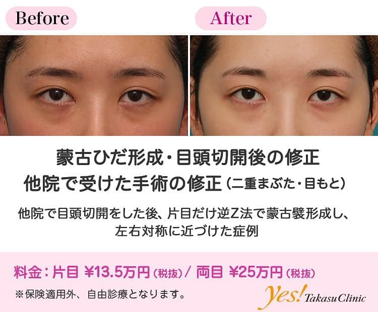 高須クリニックのインスタグラム：「👨🏻‍⚕️高須幹弥医師からのコメント✨⠀ 20代女性の患者様で、目頭切開の修正手術希望で、来院されました。 6ヶ月以上前に、他院で両目の目頭切開を受けたとのことでした。 診察させていただいたところ、左目よりも右目のほうが切り込まれており、涙丘（目頭の赤い粘膜の膨らんだ部分）も多く露出しており、左右差が目立っていました。 前医での目頭切開の術式は、傷跡だけを見てもよく分かりませんでした。 Z法なのか、内田法でWの字に切開したつもりなのか、三日月型に皮膚を切除して縫合しただけなのか、不明でした。 ただ、左目に比べ、右目のほうが傷跡が目立っていました。 患者様は、「左目はいいので、右目だけを修正し、左目と同じような下向きの蒙古襞を作って、なるべく左右対称にしてほしい」というご要望だったので、右目のみ蒙古襞形成手術をすることになりました。 手術は逆Z法で行い、前医での目頭切開の傷跡を含めてフラップ（皮弁）にし、下向きの蒙古襞になるように回転させ、固定しました。 フラップのあった部位は中縫いはせず、丁寧に皮膚の表面を縫合しました。 術後は、綺麗に下向きの蒙古襞ができ、ほぼ左右対称の涙丘の見え具合、目の横幅になりました。 また、結果的に、前医での目頭切開の傷跡が目立たなくもなりました。 ---------------------------------------------------- 🌈料金✨⠀ ●蒙古ひだ形成・目頭切開後の修正 片目 ¥135,000 / 両目 ¥250,000【東京、横浜、名古屋、大阪】 ---------------------------------------------------- ⚠️リスク・副作用・合併症✨⠀ ●蒙古ひだ（蒙古襞）形成・目頭切開後の修正 内出血（術後） 仕上がりのわずかな左右差（完璧なシンメトリーは不可） 仕上がりが完璧に自分の理想の形にならないことがある --------------------------------------------------- 😊施術についての詳細✨⠀⠀ https://www.takasu.co.jp/photo/hida07.html ---------------------------------------------------- 📞ご予約・お問い合わせ✨⠀ 0120-5587-10⠀ https://www.takasu.co.jp/cgi-bin/form/contact.cgi ※症例写真や施術に関するご質問なども上記までお願い致します。 ---------------------------------------------------- #蒙古ひだ形成 #目頭切開後の修正 #他院で受けた手術の修正  #皮膚 #美容 #美肌 #エイジングケア #美容整形 #美容外科 #美容クリニック #美容好き #美容皮膚科 #モニター #モニター募集 #高須クリニック #高須クリニック名古屋 #高須幹弥 #整形したい #プチ整形 #症例 #症例写真 #可愛くなりたい #可愛い #美人」