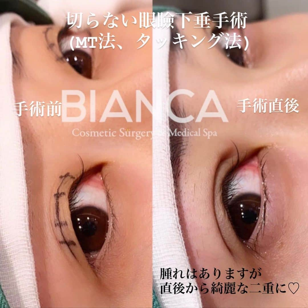 辻沢由有（BIANCA CLNIC 表参道院 院長）さんのインスタグラム写真 - (辻沢由有（BIANCA CLNIC 表参道院 院長）Instagram)「#dryuu目　#dryuu二重 ▶︎swipeで文字なし症例写真♡▶︎  【ぼやけたラインもくっきり♡】 ﻿ ﻿※直後なので腫れがあります  切らない眼瞼下垂の手術であるMT法（タッキング法）により 目の開きが良く、ナチュラルに大きな目にしました☺️ ﻿ 左　術前﻿ 右　術直後 ﻿ ﻿ MT法は、特殊な極細⽷でまぶたの裏側の筋⾁を縫い縮めることで⽬の開きを良くする⼿術です。 ﻿ 🌸瞼の開きが悪く⿊⽬が隠れる﻿ 🌸眠そうに⾒える﻿ 🌸⽬つきが悪いと⾔われる﻿ ﻿ などの眼瞼下垂特有の症状を改善することができます✨﻿ 眼瞼下垂が改善されると、頭痛や肩こり、全⾝の疲労感も緩和されます❣️﻿ その他、三重やくぼみ目の解消にも効果的です🥰﻿ ﻿ 現在、お得なモニター様も募集しています。﻿ 私も適応かも？と思った方は、一度ぜひカウンセリングにお越しください✨﻿ ﻿ ﻿ 💉眼瞼下垂（MT法）﻿ 💴298,000円 😷腫れ 内出血:数日〜1週間程度﻿ ﻿ ⚠️ご予約の際は﻿ 『Dr Yuu（辻沢）のインスタ見た』の一言をお願いします👩‍⚕️✨﻿ ﻿ 📍BIANCA CLINIC﻿ ✔︎表参道院﻿ 03-6433-5994﻿ 東京都港区南青山5-11-10  南青山511ビル 2F﻿ ✔︎銀座院﻿ 03-6263-2690 ﻿ 東京都中央区銀座1-5-6 銀座レンガ通り福神ビル 4F﻿ 診療時間 10:00〜19:00﻿ 年中無休（年末年始を除く） ﻿ ﻿ ﻿ ﻿ #美容好き#プチ整形#美魔女#美容好きな人と繋がりたい#美容垢#綺麗になりたい #美容皮膚科 #美容外科 #cosmeticsurgery #plasticsurgery #biancaclinic #ビアンカクリニック  #followｍe #フォローミー  #女医 #モニター募集 #モニター募集中#若返り #イメチェン #二重切開 #二重埋没 #二重整形  #二重になりたい #ヒアルロン酸 #女医 #アンチエイジング #埋没法 #beauty #二重埋没法」1月23日 9時33分 - i_am_yuu__