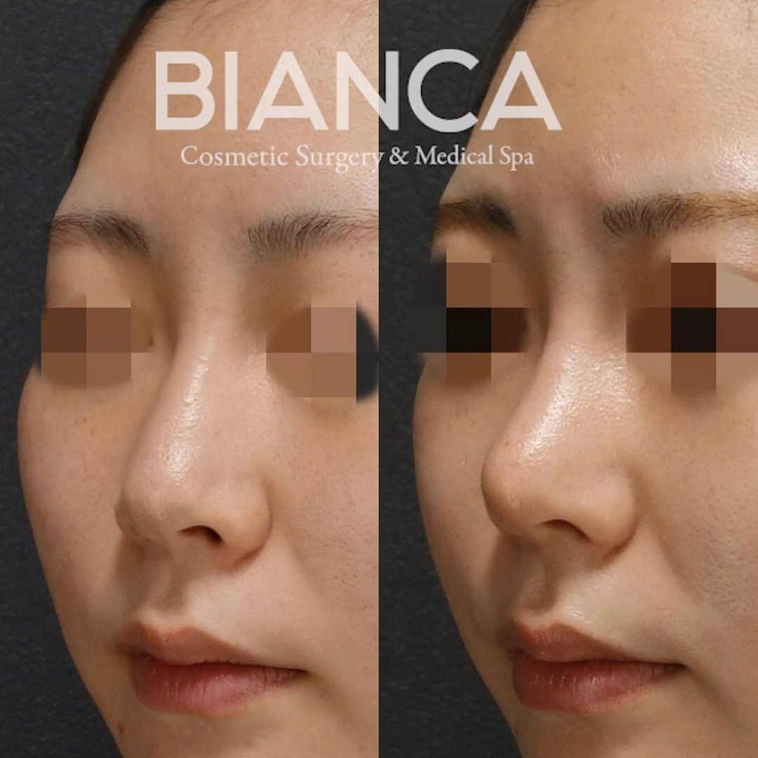 辻沢由有（BIANCA CLNIC 表参道院 院長）さんのインスタグラム写真 - (辻沢由有（BIANCA CLNIC 表参道院 院長）Instagram)「#dryuu鼻  ▶︎swipeで文字なしの症例写真▶︎ 【鼻先を整える✨】﻿ ﻿ ✔︎鼻尖縮小で鼻先をシャープに土台づくり﻿ ✔︎耳介軟骨移植で更に整えました﻿ ﻿ 左 手術前﻿ 右 術後1ヶ月﻿ ﻿ 💴耳介軟骨移植 300,000円 ﻿  鼻尖縮小 348,000円 ﻿ 🤕 ギブス固定:72時間 抜糸:1週間後﻿ 😷 腫れ・内出血: 10日前後 ﻿ ⚠️ご予約の際は﻿ 『Dr Yuu（辻沢）のインスタ見た』の一言をお願いします👩‍⚕️✨﻿ 🔜﻿ ﻿ 9月勤務日🎑﻿ 表参道院﻿ ↪︎1 3 6 14 16 19 21 24 27 30﻿ 銀座院﻿ ↪︎2 5 17 18 20 22 25 26﻿ ﻿ 📍BIANCA CLINIC ﻿ ✔︎表参道院﻿ 03-6433-5994﻿ 東京都港区南青山5-11-10  南青山511ビル 2F﻿ ✔︎銀座院﻿ 03-6263-2690 ﻿ 東京都中央区銀座1-5-6 銀座レンガ通り福神ビル 4F﻿ 診療時間 10:00～19:00﻿ 年中無休（年末年始を除く）﻿ ﻿ #beauty #plasticsurgery #cosmeticsurgery #liposuction #threadlift #threadlifting #antiaging #美容外科 #美容皮膚科 #美容整形 #プチ整形 #整形 #美魔女 #鼻整形 #耳介軟骨移植 #鼻尖縮小 #鼻プロテーゼ #鼻ヒアルロン酸 #韓国整形 #オルチャンメイク #biancaclinic #ビアンカクリニック #dryuu鼻 #フォローミー #followme」1月23日 14時11分 - i_am_yuu__