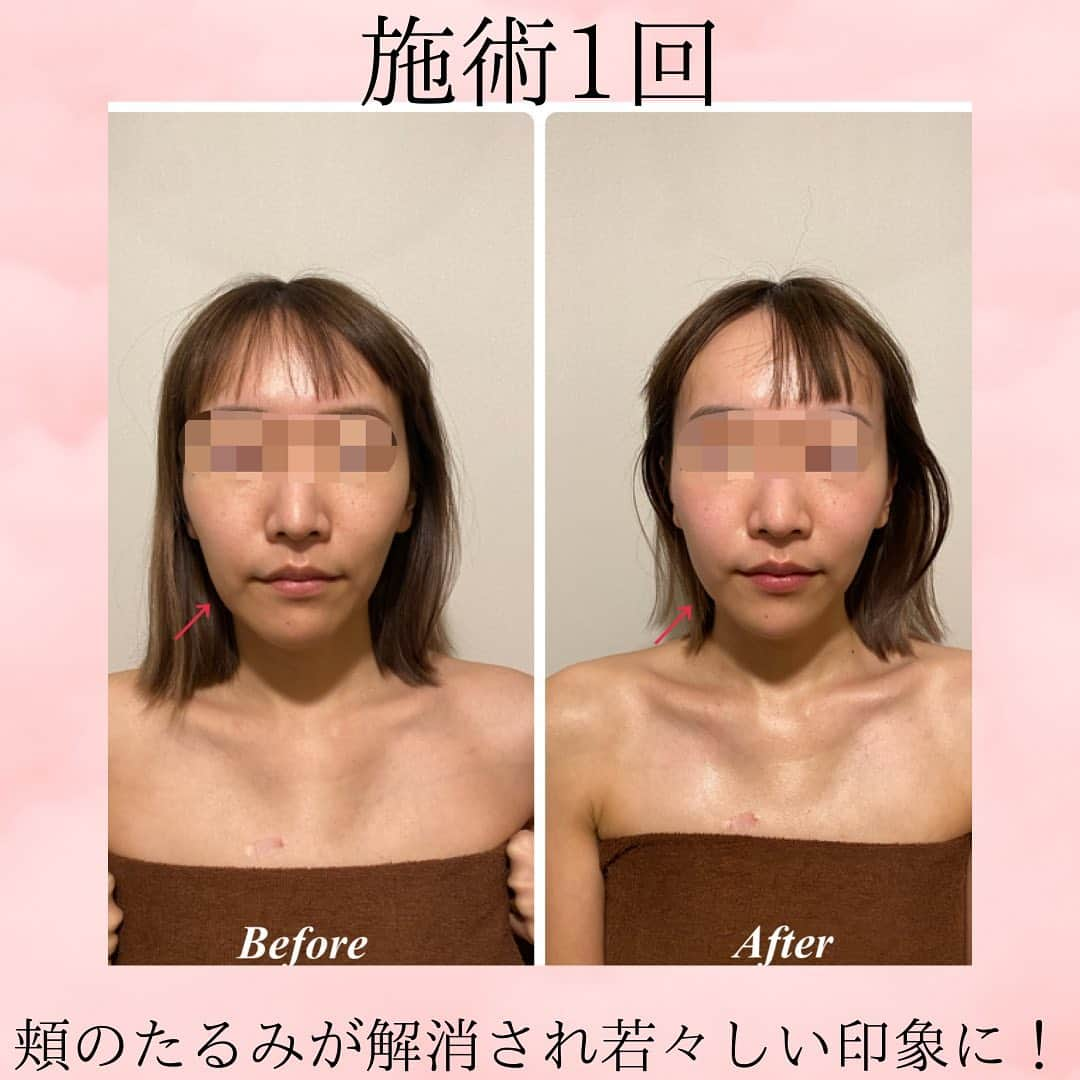 Eternal Total Beauty Salonのインスタグラム：「【ビフォーアフター】  全体的にリフトアップして 肌艶も良くなりました☺️  インディバでむくみを取り リフトアップ！  その後にオールハンドで 歪みを整えながらさらに リフトアップ✨  2回目、3回目と回数を重ねていく毎にどんどん お顔が小さく、左右対称に 近づいていきますよ♪  嬉しい感想もありがとうございます💖  次回の変化も楽しみですね！  ＊＊＊＊＊＊＊＊＊＊＊＊＊＊  恵比寿駅西口徒歩4分♪ インディバエステ/小顔・痩身  営業時間　11:00〜21:00(19:00最終受付)  定休日　不定休  Tel 0364163830 お電話はつながり難い事が多いのでDMもしくはトップページの予約サイトから🙇‍♀️ 【@beautylian.111】  ＊＊＊＊＊＊＊＊＊＊＊＊＊＊  #インディバ  #インディバエステ  #インディバサロン  #インディバ専門店  #恵比寿インディバ  #恵比寿小顔  #小顔 #コルギサロン  #小顔矯正 #ビフォーアフター #ビフォーアフター写真  #セルライト除去  #免疫力を高める  #結果の出るサロン #えらはり改善  #エラ張り解消  #左右差が整います  #むくみ防止  #浮腫み解消  #浮腫まない顔 #冷え性改善  #体質改善 #高周波 #美と健康 #リフトアップ #エニシーグローパック正規取扱店」