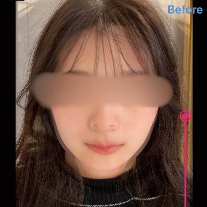 のインスタグラム：「川島式小顔矯正  15分before after. . #整体Filament #整体 #小顔矯正 #美容」