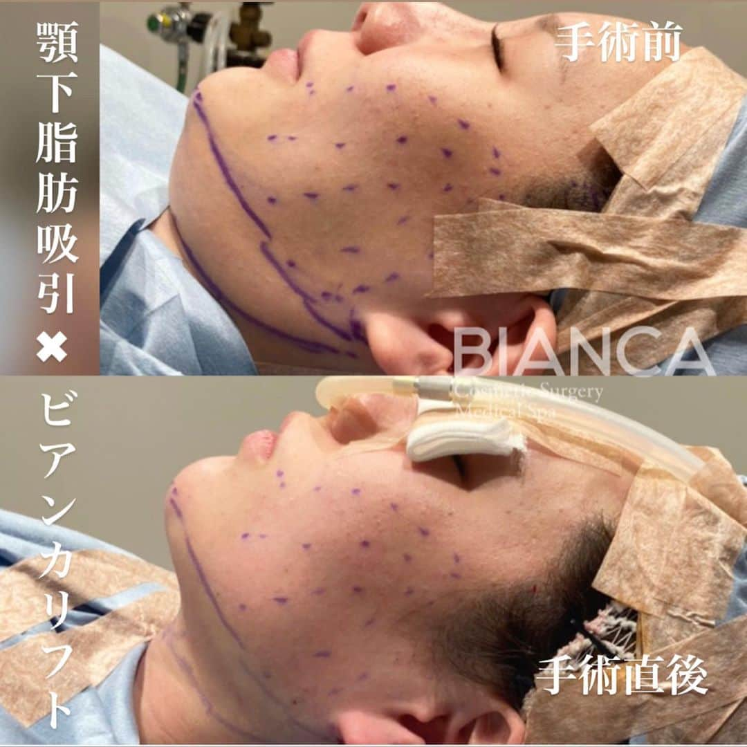 辻沢由有（BIANCA CLNIC 表参道院 院長）さんのインスタグラム写真 - (辻沢由有（BIANCA CLNIC 表参道院 院長）Instagram)「#dryuu小顔﻿ ▶︎swipeで文字なし症例写真▶︎﻿ ﻿ 顎下の脂肪吸引✖︎BIANCALIFT﻿ 小顔の最強コンビ！！﻿ ﻿ 上　手術前﻿ 下　手術直後﻿ ﻿ 直後から明らかにスッキリ✨﻿ 男女問わずおすすめです❣️﻿ モニター様も募集中です☺️﻿ ﻿ 🌸BIANCALIFT 10本／ 300,000円﻿ ▶ 🉐モニター 198,000円﻿ ﻿ 🌸顎下脂肪吸引 248,000円 ﻿ 🤕 フェイスバンド固定 72時間﻿ 😷 腫れ・内出血: 10日前後﻿ ⚠️リスク:感染・凹凸・ひきつれ・血腫など ﻿ ﻿ ﻿ ⚠️ご予約の際はお電話にて﻿ 『Dr Yuu（辻沢）のインスタ見た』の一言を必ずお願いします👩‍⚕️✨﻿ ﻿ 📍BIANCA CLINIC﻿ ✔︎表参道院﻿ 03-6433-5994﻿ 東京都港区南青山5-11-10  南青山511ビル 2F﻿ ✔︎銀座院﻿ 03-6263-2690 ﻿ 東京都中央区銀座1-5-6 銀座レンガ通り福神ビル 4F﻿ 診療時間 10:00～19:00﻿ 年中無休（年末年始を除く）﻿ ﻿ ﻿ #美容好き#プチ整形#美魔女#メンズ美容 #美容垢#綺麗になりたい #美容皮膚科 #美容外科 #cosmeticsurgery #plasticsurgery #biancaclinic #ビアンカクリニック #プレ花嫁さんと繋がりたい #followｍe #フォローミー #銀座 #女医 #モニター募集 #モニター募集中﻿ #若返り #リフトアップ #スレッドリフト #メンズエステ #メンズビューティー  #小顔 #たるみ #たるみ治療#女医 #ダイエット#dryuu小顔」1月24日 14時05分 - i_am_yuu__