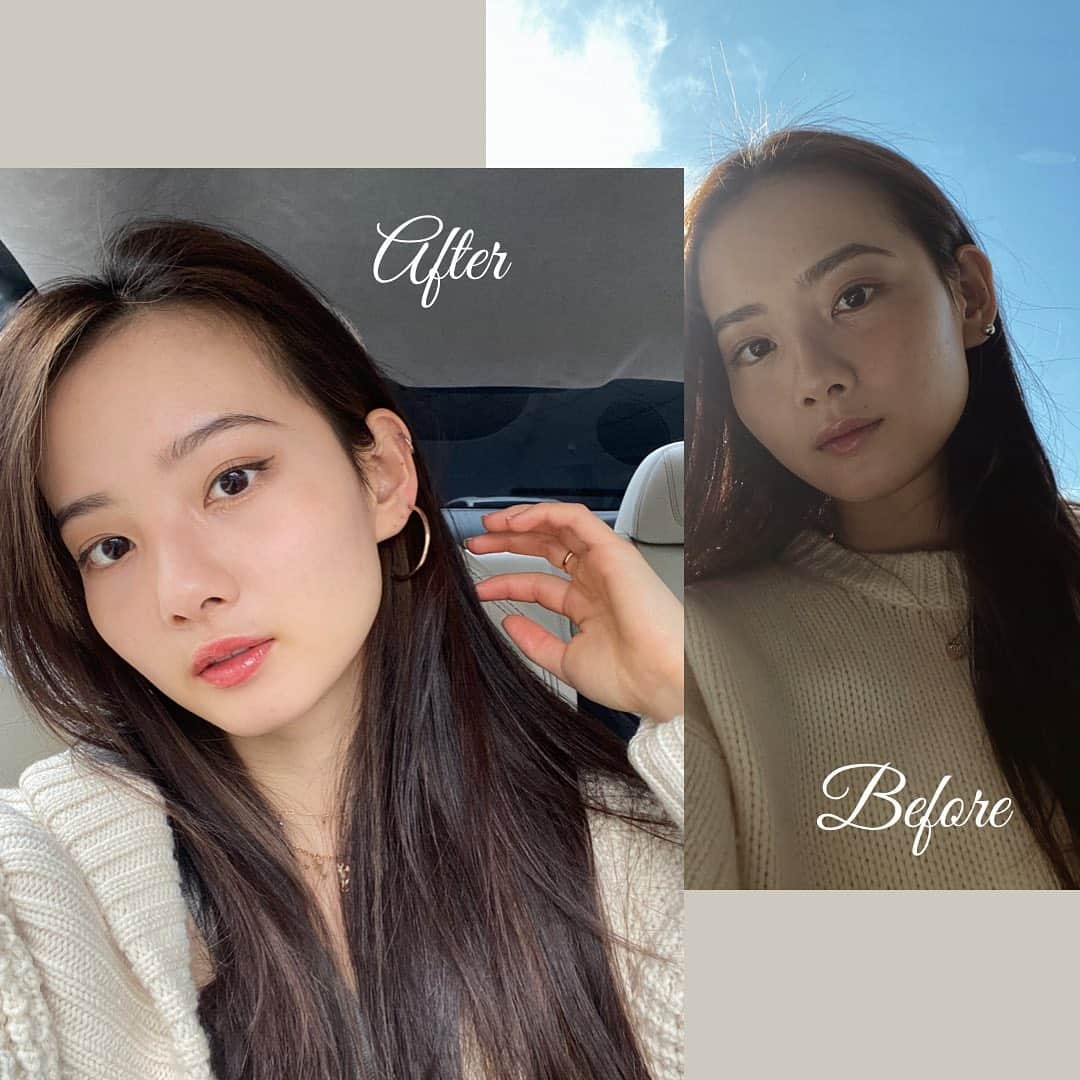 のインスタグラム：「東京中央美容外科渋谷東口院 @tcb_shibuyahigashi HIFU(ハイフ)•ソノクイーンの経過観察に来ました。  before & after  顔のラインが変わってとっても嬉しい！ 塩満先生　@tcb_shiomitsu も他のスタッフさんもありがとうございます。これからも続きますように✨  #リフトアップならTCB東京中央美容外科 #美容整形ならTCB東京中央美容外科 #東京中央美容外科 #東京中央美容外科渋谷東口院 #美容外科 #塩満院長 #塩満ドクター #渋谷東口　#塩満恵子 #ソノクイーン #ソノクイーンなら #ハイフ #HIFU #リフトアップ #pr」