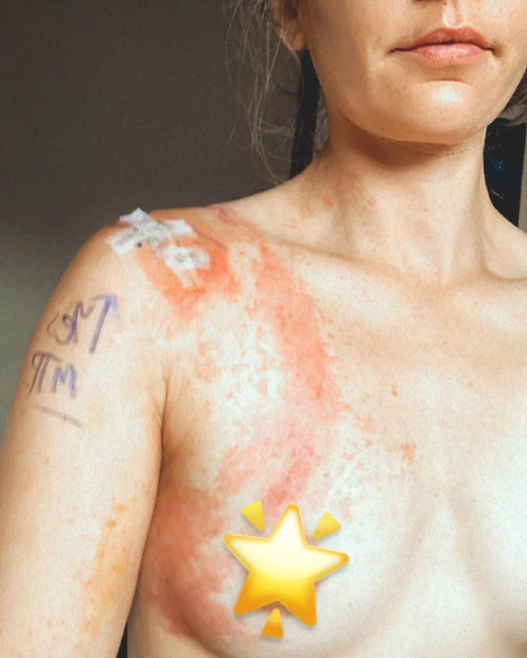 チェルシー・ルーズさんのインスタグラム写真 - (チェルシー・ルーズInstagram)「Dear Body -   I recently verbally stated how gross you were. You still have betadine (I think) stained on your surgical shoulder (as well as your surgeon’s initials in purple ink), hairy legs and armpits (which aren’t gross, but just not a personal preference), and an increasingly worsening rash, but thankfully seems to be better today. Let’s not forget the left shoulder that is restricted from actively moving on its own terms for now. And yea, you kinda smell, too.   When I caught myself saying this aloud, I stopped immediately and felt quite guilty for insulting you based on things outside of your control. I knew I needed to be more kind to you - so I reframed my dialogue.   First, I am so thankful for you and how resilient you are. Sometimes it’s easy for me to forget or lose sight of, but wow. You’ve done so many things in this lifetime that I’m proud of, so thank you. Second of all, while this time right now has been shitty primarily because of this rash, it’s been nice to just be with you and practice our mental fortitude. We still have some weeks/months before we will be climbing again, but that’s ok. We have a lot of other focuses we get to hone in on and as of today I’m SO EXCITED to get started on.  So I’ll leave this with a big thank you for being resilient, bad ass, imperfect in the best of ways, and fighting alongside me. You’re the greatest.   Warmly, Chelsea  @alexaristei photo #1」1月25日 7時18分 - chelseanicholerude