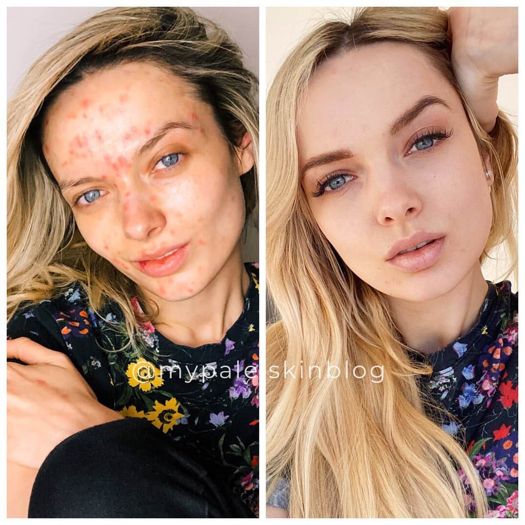 エム・フォードのインスタグラム：「Sometimes the biggest changes are the ones you can’t see 💗. ⠀ When I decided to start posting myself online without makeup back in 2015, I took the concealer from my face away, but somehow ended up concealing the darkness in my personal life instead.  ⠀ You may see the difference in my skin, but what you don’t see is the difference in my mind, my heart, my body, my sleep, my anxiety, the way I walk, even the way I talk. ⠀ If I can show you skin with acne can be beautiful, I hope I can show you that surviving trauma, abuse, and rebuilding your life can be beautiful too 💗.」