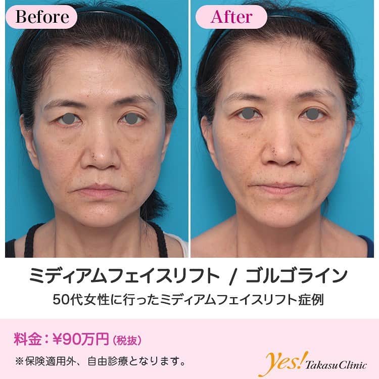 高須クリニックのインスタグラム：「👨🏻‍⚕️高須幹弥医師からのコメント✨⠀ 50代女性の患者様で、頬のたるみや法令線が気になり、全体的なエイジングケア目的で来院されました。 切ることには抵抗はなく、1週間以上顔が腫れても大丈夫ということだったので、ミディアムフェイスリフトをすることになりました。 髪の毛の中から耳の前にかけて皮膚を切開し、リテイニングリガメントを外した後、SMASの処理をし、余分な皮膚を切除して、丁寧に皮膚を縫合しました。 強い腫れは1週間程度で引きます。 1週間後に全て抜糸しました。 術後はフェイスラインがすっきりし、法令線が浅くなりました。 また、頬のたるみが上がったことにより、顎の下や首のたるみも改善しました。 この方は全体的に痩せており、元々顔のボリュームがあまりないため、ヒアルロン酸を注射や脂肪注入をすると、更にエイジングケアできます。 ---------------------------------------------------- 🌈料金✨⠀ ●ミディアムフェイスリフト ¥900,000【東京、横浜、名古屋、大阪】 ---------------------------------------------------- ⚠️リスク・副作用・合併症✨⠀ ●ミディアムフェイスリフト 切開した周辺の腫れ（術後） 仕上がりのわずかな左右差（完璧なシンメトリーは不可） 傷跡が肥厚性瘢痕やケロイドになる可能性 感覚が鈍くなる可能性 手術後の血腫 --------------------------------------------------- 😊施術についての詳細✨⠀⠀ https://www.takasu.co.jp/photo/mediumlift_pic09.html ---------------------------------------------------- 📞ご予約・お問い合わせ✨⠀ 0120-5587-10⠀ https://www.takasu.co.jp/cgi-bin/form/contact.cgi ※症例写真や施術に関するご質問なども上記までお願い致します。 ---------------------------------------------------- #ミディアムフェイスリフト #ゴルゴライン #頬のたるみ #法令線 #たるみ改善 #皮膚 #美容 #美肌 #エイジングケア #美容整形 #美容外科 #美容クリニック #美容好き #美容皮膚科 #モニター #モニター募集 #高須クリニック #高須クリニック名古屋 #高須幹弥 #整形したい #プチ整形 #症例 #症例写真 #可愛くなりたい #可愛い #美人」