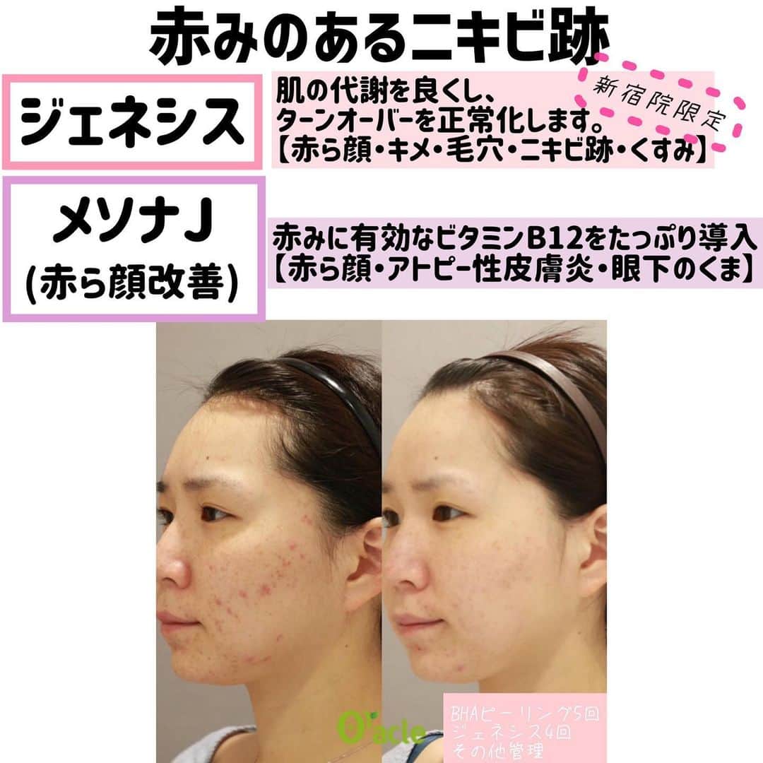 オラクル美容皮膚科東京新宿院さんのインスタグラム写真 - (オラクル美容皮膚科東京新宿院Instagram)「📝フォロワー様からの質問﻿ Q.そばかすとニキビ跡が気になっています。おすすめはありますか？﻿ ﻿ ﻿ A.そばかすにはルメッカ❣﻿ ルメッカは濃いシミ、薄いシミ、そばかす、赤ら顔に効果的です✨﻿ 業界トップクラスのピークパワーの為、﻿ 少ない回数で治療ができ、効果を実感して頂けます！﻿ ﻿ シミやそばかすのお悩みのない方でも﻿ 美白効果目的で施術される方もいらっしゃいます😍﻿ ﻿ ﻿ ⭐赤みのあるニキビ跡ですと「ジェネシス」「メソナJ赤ら顔改善コース」がおすすめです！﻿ 👇ジェネシスの効果﻿ ・赤ら顔改善﻿ ・キメが整い、ハリが出る﻿ ・毛穴、ニキビい跡の改善﻿ ・くすみ改善﻿ ﻿ お肌の代謝を良くし、ターンオーバーを正常化してくれます✨﻿ ﻿ 👇メソナJ赤ら顔改善コース﻿ 赤みに有効なビタミンB12をエレクトロポレーション法で﻿ たっぷり導入していきます✨﻿ ﻿ 赤ら顔、アトピー性皮膚炎、眼下のくまに効果的です😊﻿ ﻿ 直後から赤みが取れ、続けることで赤みの出にくいお肌に導きます♥﻿ ﻿ 【料金】﻿ ・ルメッカ﻿ 初回トライアル﻿ 頬上部or下部　18,000円(税抜)﻿ 全顔1回　25,000円(税抜)﻿ ﻿ ・ジェネシス(新宿院限定)﻿ 顔1回　10,000円(税抜)﻿ ﻿ ・メソナJ赤ら顔改善コース﻿ 顔1回　18,000円(税抜)﻿ ﻿ ﻿ ▪️▫️▪️▫️▪️▫️▪️▫️▪️▫﻿ ﻿ 🇯🇵オラクル美容皮膚科🇰🇷﻿ 📍東京新宿院﻿ 新宿3丁目19-4 MLJ新宿8階﻿ ﻿ 📍名古屋院﻿ 名古屋市中区錦3丁目24-4﻿ サンシャイン栄5階﻿ ﻿ 【専門】﻿ ニキビ（跡）／毛穴／シミ／しわ／たるみ／痩身／アンチエイジング／美白美肌治療全般／ブライダル相談／メンズ美容﻿ ﻿ 🗝完全予約制﻿ 👠土日祝日も診療﻿ ﻿ 【予約方法】﻿ ☎0120-905-696﻿ ⏰9:00～21:00［年中無休］﻿ ﻿ LINE、メール24時間📧﻿ LINE🆔 @oracle.jp ﻿ 📩HPメールフォームよりお願いいたします﻿ ﻿ ﻿ ▪️▫️▪️▫️▪️▫️▪️▫️▪️▫️﻿ ﻿ ﻿ ﻿ ﻿#オラクル美容皮膚科 #オラクル #oracle #美容皮膚科 #ルメッカ #メソナj #メソナjプラス #ジェネシス #そばかす #そばかす消したい #シミ #シミケア #ニキビ跡 #ニキビ跡ケア #ニキビ跡改善 #ニキビ #美白 #美白ケア #美肌 #韓国美容 #韓国 #美容 #美容好き #美容好きな人と繋がりたい #美容垢 #オラクルルメッカ」1月27日 15時09分 - oraclejp