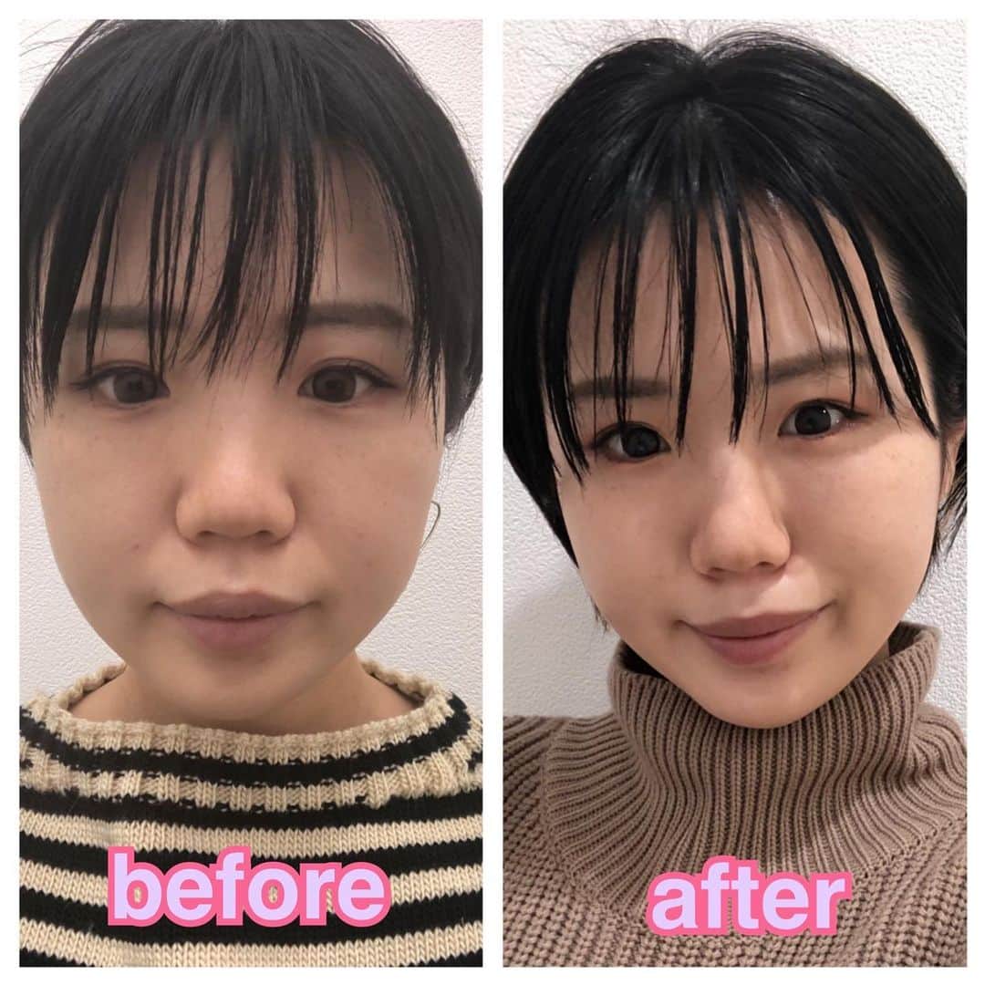 森本レオ子さんのインスタグラム写真 - (森本レオ子Instagram)「東京中央美容外科 大宮院（@tcb_omiya）でTCB式小顔美肌再生を施術して頂いてから、1ヶ月が経過しました。  どちらもiPhoneⅩのインカメラにて撮影、無加工の画像になります。施術前と1ヶ月後ではかなりたるみにも差が出ましたね😆😆  痛みの引きも早かったし、これはやって良かった🥰🥰🥰これからも定期的にやろうー🧝‍♀️🧝‍♀️  樅山先生（@tcb_momiyama）ありがとうございました！  #リフトアップならtcb東京中央美容外科 #美容整形ならtcb東京中央美容外科 #tcb式小顔美肌再生 #東京中央美容外科 #東京中央美容外科大宮院 #大宮 #樅山真紀 #小顔美肌再生 #リフトアップ #美容外科 #pr #れおこぽん #森本レオ子」1月28日 8時54分 - leocodon