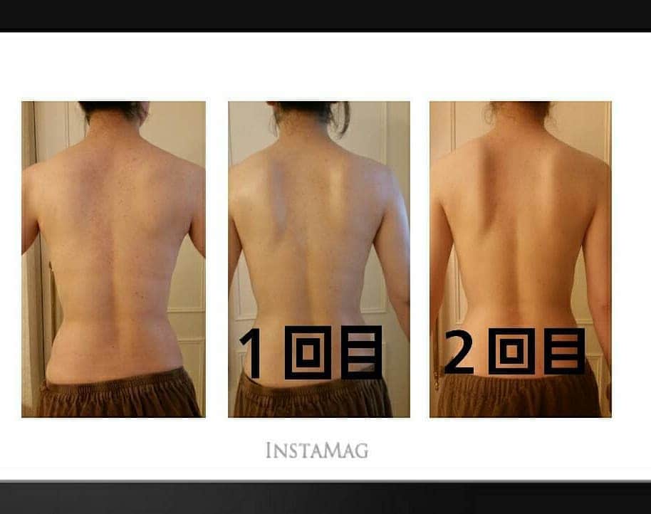 SiS Total Beauty 〜シス〜のインスタグラム：「人気No1！ハーブピーリング✨ お顔だけではなく ボディにも施術可能です🙋‍♀️ ． 〜こんなお悩みをお持ちの方に〜 ⭕️色素沈着（黒ずみ） ⭕️ニキビ ⭕️ざらつき ⭕️シミ ． 植物幹細胞のチカラで 肌の再生を促し 美肌に導きます✨  詳しい詳細はお電話または ＤＭ等で承ります💡 どしどしお問い合わせ下さい⛄🎄✨ . . お問い合わせは下記まで↓  SiSTotalBeauty 大阪市西区南堀江1-15-10ソレイユ南堀江2階 四ツ橋駅6番出口より徒歩5分 なんば駅・心斎橋駅徒歩7分 📞06-6541-8222 平日10時〜21時 土日祝10時〜19時  #ハーブフェイシャル #ハーブピーリング #フェイシャル #毛穴レス #ヒト幹細胞フェイシャル #ヒト幹細胞 #水光注射 #フェイシャル専門店  #クリスマス #エステサロン  #ボディハーブ  #ピーリング  #黒ずみケア  #ニキビ改善  #背中ニキビ  #ダウンタイムなし #エステサロン  #ボディハーブ  #ピーリング  #黒ずみケア  #ニキビ改善  #背中ニキビ  #ダウンタイムなし」