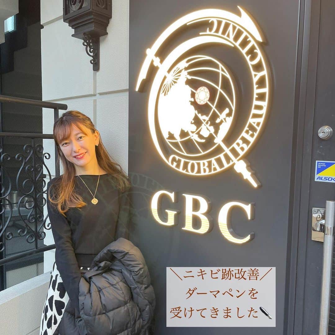 菊池かなこのインスタグラム：「. ダーマペン✒️受けて来ました！ ニキビ跡改善出来て、凸凹がなくなると聞いて気になってたダーマペン . 元麻布の @global_beauty_clinic ダーマペン＋イオン導入です . 写真1枚目は施術当日の肌👧 赤みが当日はかなりあります.. ダウンタイムは1週間くらいあるかもと聞いていたけど、 私は２日くらいで赤みが引いて 皮がペリペリ剥ける感じはあるものの 4日くらいでつるつるになりました！ . 1回ではそこまで効果ぎ出ないかと思っていたけど、 かなりつるつる！ 5回位必要みたいなので、続けてみたい . 最新の機械で肌の奥にあるシミ予備軍が見えるんだけど、 無いと思ってたシミが割とあって恐怖🤭 ゼオスキンという基礎化粧品シリーズを使うと 改善出来るみたいで デパコスをシリーズで揃えたりするよりも実際安そうなので 試してみたいと思っています！ . . . ୨୧┈┈┈┈┈┈┈┈┈┈┈┈┈┈┈┈┈୨୧ @global_beauty_clinic @doctor_yuriko @yurikohayata #グローバルビューティークリニック #麻布十番クリニック #ステムリッチフェイシャル #ダーマペン#ダーマペン治療#ニキビ跡改善#肌ケア#再生美容 #美容レポ」