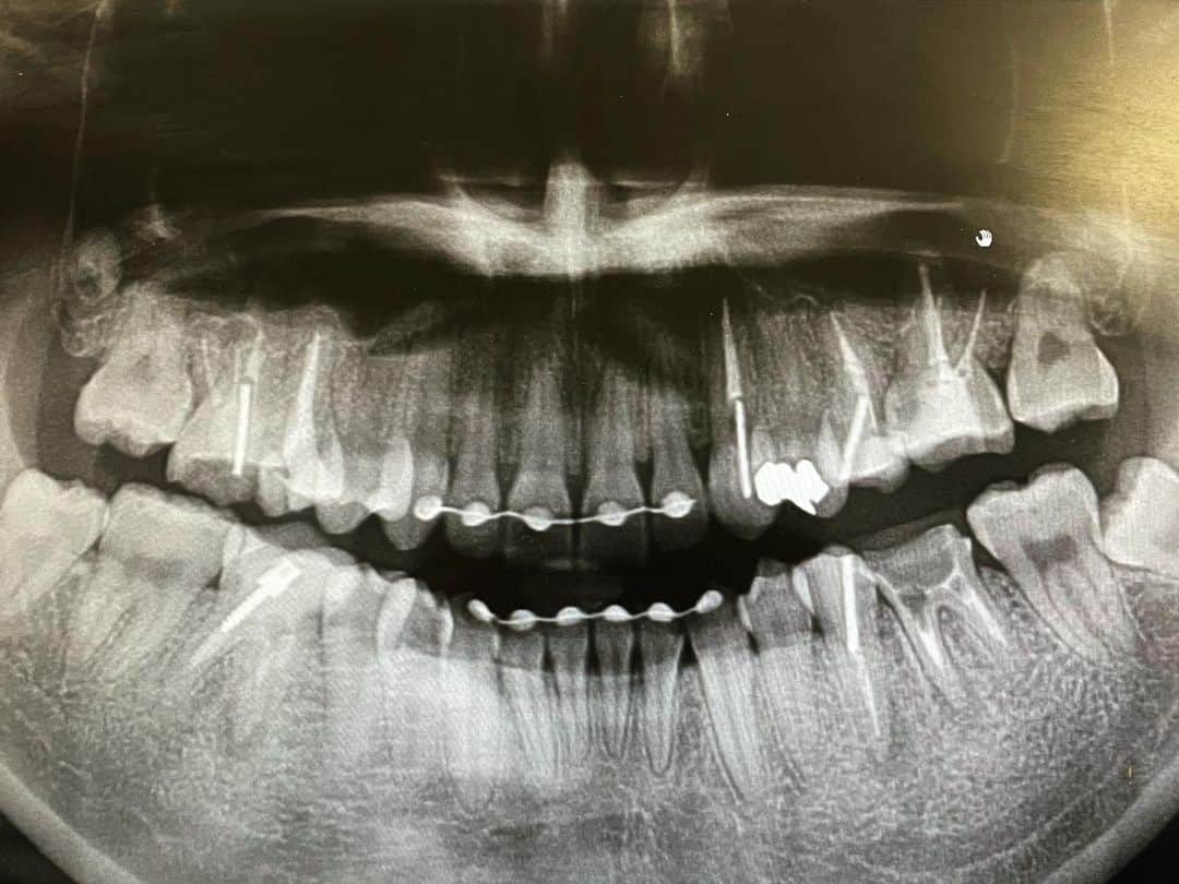 北澤舞悠（まゆちる）のインスタグラム：「My tooth🦷」