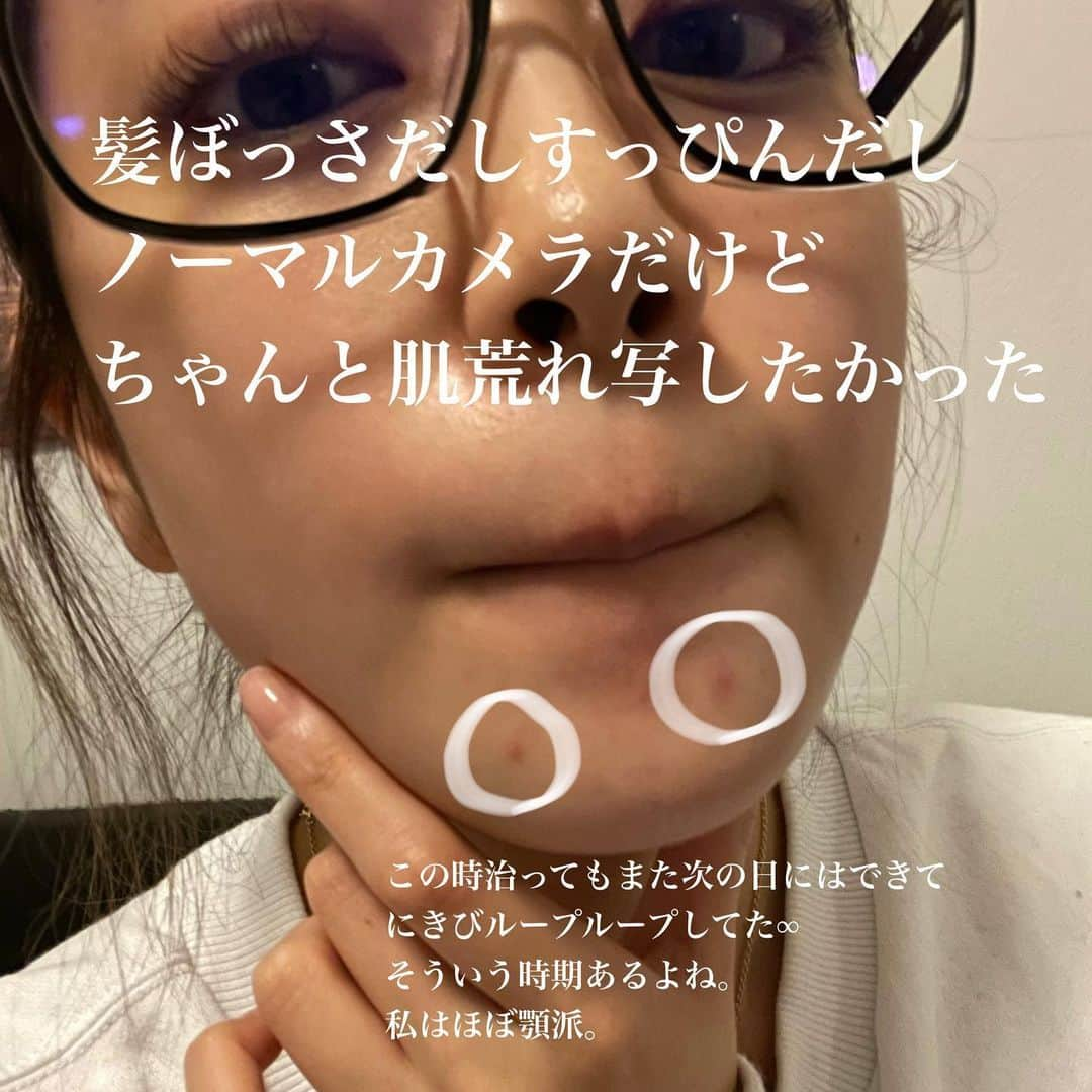 川嶋麗惟さんのインスタグラム写真 - (川嶋麗惟Instagram)「. . 【私のにきび撲滅法】 . . 最初に注意点なのですが 肌質や合う合わないは個人差があります。 ですので、今回紹介するのは あくまでも私に合っていたものです。 でも肌荒れやニキビに悩んでる方も いらっしゃると思うので 参考程度に読んでみてください。 . . まずは津田コスメのバーム！ バームだけでなく、もちろんラインでスキンケアを 出されていて試したこともあります。 私は元々敏感肌ではないので 劇的に肌が変わった！！という実感は なかったのですが 肌荒れした時の力の発揮具合が◎ 特にこのバームは最強でした。 赤みが出やすい私の肌にも合うし なにより乾燥肌にとって最強でした。 ニキビが出来ていてもたっぷり塗って寝たら 次の日には落ち着いてるという… びっくりました。 乾燥してるこの季節にとってもおすすめ！ . . 次はプレバリンαクリーム これは私の救世主、安心材料。 もちろん留学にも持ってきました。 留学に来てからすぐに 結構肌荒れが続いてしまって かなーり大きいニキビが治っては出来ての繰り返し。 水もちがうし環境も違うから仕方ないけど🤷🏼‍♀️ 画像にも書いたけど ニキビにこんもり塗って絆創膏を貼ります。 寝てる間に取れちゃうからね。 これを3日間くらい続けるとかなり鎮静されます。 . . 最後にリポカプセルビタミンC！ 肌荒れは内面から変えるのも大事。 やっぱりビタミンCだよね🧡🧡 このリポカプセルは、沢山の美容家さんも 飲んでるくらい有名なビタミン剤。 サプリメントってほとんど普段飲まないし 飲んだこともなかったんだけど これだけは続けやすいし続けようと思ってます。 . . こんなこと言ってるけど 肌荒れが長引く時とかは皮膚科に駆け込んでね。 跡になったりクレーターになったりしちゃうニキビもあるから。 . . #スキンケア #スキンケアマニア #スキンケア用品 #スキンケア好きさんと繋がりたい #スキンバリアバーム #津田コスメ #プレバリンαクリーム #リポカプセルビタミンc #リポソーム #リポソームビタミンc #ニキビケア #ニキビ跡 #にきびケア #肌荒れ改善 #肌荒れケア #肌荒れ対策 #ニキビ撲滅 #ぴえん #ニキビ肌 #ニキビ改善 #にきび治療 #たまご肌」1月31日 21時59分 - rei.kawashima