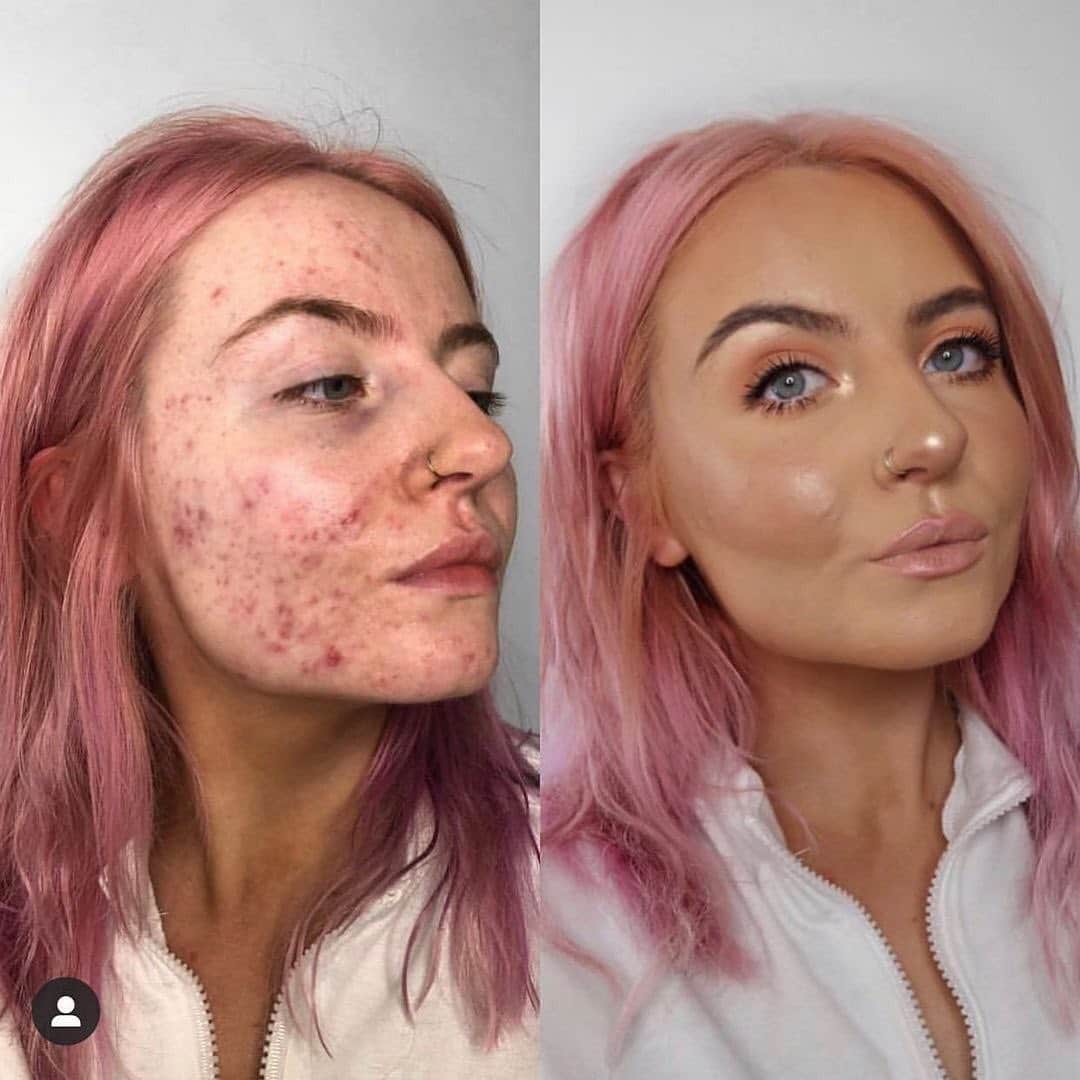 Huda Kattanさんのインスタグラム写真 - (Huda KattanInstagram)「Same beautiful woman, @abbiebull_, new & improved #FauxFilter made by you guys 🙏🏽 Love you soooo much gorgeous 💕💕 #repost "My before & after now compared to 2 years ago! Thought it’d be cool to do this since the original post was me showing coverage of @hudabeauty faux filter foundation and 2 years later shes released a new one! Also a reminder that hard times don’t last forever... My journey with acne was rough but I’m thankful more than ever for who I was then as she made me so much stronger today 💗 #skinpositivity #fauxfilterfoundation"」2月1日 19時59分 - hudabeauty