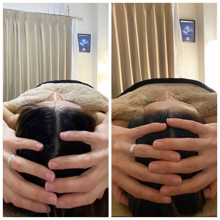 齋藤美波さんのインスタグラム写真 - (齋藤美波Instagram)「💆🏻‍♀️💆🏻‍♀️💆🏻‍♀️ #脳洗浄 ・ いきなりどスッピン写真失礼🙇🏾‍♀️ この間は初めての脳洗浄 PARAFUREの施術を受けてきました🤍 脳洗浄というと え？脳？脳の中の洗浄？ ってなる人が大半だと思います。笑 私もそうでした🤣 ・ でも本当に本当に一回でこの効果 感動しすぎたので是非ともみんなに ご紹介したいと思って、、、 是非とも長いけど見てほしい！！😳 🔻🔻🔻 【PARAFUSE〜脳洗浄〜】 脳脊髄液へのアプローチからお顔の歪みや浮腫・たるみ・頭のハチと言った外見的な状態、そして、頭痛や肩凝り・睡眠の質の向上や自律神経を整えていくPARAFUSE.独自のメソッドです。 全身の緊張をほぐしリラックスしていただきます。 小顔や美容だけでなく健康にもこだわった欲張りな新しいエステです。 脳洗浄とは ひとことで言うと頭の中の老廃物（死滅した細胞のごみ）を流すことです。 頭の中にも老廃物が溜まります。 その老廃物を流す重要な役割を果たすのが脳脊髄液です。 🔺🔺🔺 だそうです！！ ・ あたしも色んなエステやってきたけど 初めてのエステで最初ドキドキして 挑んだけど、まぁ〜気持ちいい。。💓笑 全然強い力使わず、 ただただエステ堪能してた😍 途中途中飛んで記憶ないくらい。笑 ・ 気持ちよかったなぁ〜 ・ 美容鍼もやって最近顔が引き締まってきてるから そんなに変化ないかな？って 思ったけど変化が見たかったから Befor.Afterの写真撮ってもらったら 発狂レベル🥶😱🥶😱 (写真2枚目) ・ こんなにも変わるの！？って ぐらい変化あってびっくり、、、！！ 本当にすごい！の一言。 顔全体の浮腫がなくなったのと パーツが全部キュッてなった感じ。 そして顔と頭の大きさも断然違う！！ ・ PARAFUSEを最初は定期的に 7〜10日に一回を4回に渡り施術して ベースを作るみたい。 そうすればその後は1ヶ月に一回のペースで 顔と頭の大きさも定着していくみたい✨ ・ 4回やった後の自分の顔が楽しみ♥️ ・ 旦那にも昨日 「なんか顎周りの余分な肉なくなったね。笑 前は振り向いただけでぶにってなってたのに😂」って笑いながら褒めてんだかディスってんだかわからないけど、言われた！！笑 ・ あんまあたしの美容に興味を持たない旦那だけど、 変化に気づくほど鍼とPARAFUSEのおかげなのか 確実に変化していってる😍✨ ・ こーやって効果が目に見えてると 楽しくなってくるね💕 肌も鍼やり始める前に比べたら 本当に艶と張りが出てとても調子良き🥺✨ ・ まだ一回目のPARAFUSE💆🏻‍♀️ 明後日は美容鍼🪡‼️ その後何日か後には PARAFURE♥️😁 ・ 30代2児の母ちゃん、、、 20代に負けないぞっ💪🏾💪🏾✨笑 ・ ・ 🪡美容鍼(鍼治療) @amorchigasaki  ・ 💆🏻‍♀️PARAFUSE〜脳洗浄〜 @parafuse.mayumi.shonan  ・ ・ #脳洗浄#parafuse#自律神経#浮腫#小顔#小頭#エステ#美容鍼#鍼治療#茅ヶ崎サロン#ママの味方#働くママ#ストレス発散#美肌#美容#肌艶#beauty#salon#chigasaki#shonan#amorchigasaki#parafuseshonan」2月1日 18時26分 - saito373minami