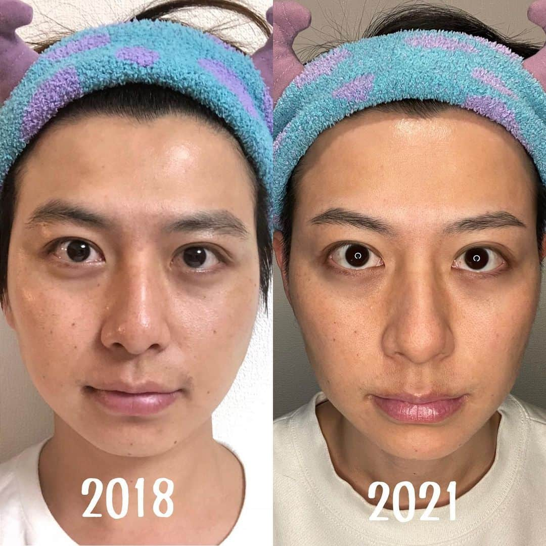 瀬戸口弘樹さんのインスタグラム写真 - (瀬戸口弘樹Instagram)「3年前と今✨  スキンケア　食事改善　トレーニング  眉毛サロン　小顔矯正　永久脱毛　美容室　など  3年間で美容の為にやってきた事✨  もちろん加工はしてません✨  綺麗になると自信がもてる‼️  キレイ＝健康✨  表だけ綺麗にしたって中がしっかりしてないとすぐにボロボロになっちゃうんですよね🥺  皆さんはちゃんとご飯食べていますか？  スキンケアは化粧水や乳液の事だけじゃない、食事もスキンケアの１つ✨  一つ一つ、口の中に入るものを気にするようにしてみてください✨  僕はよく食べている物を食べながら  まぐろ　美容　  こんなふうにネットで調べるようにしています✨  皆さんも是非調べながら食べるようにしてみてください🤗✨  そうしているうちに美容に良い食べ物がわかってくるので毎日の美容食週間が身についてきますよ✨  最後まで読んで下さりありがとうございます✨  #スキンケア　#スキンフルエンサー #美容男子　#瀬戸口弘樹　#バチェロレッテ　#メンズ美容　#メンズコスメ　#メンズビューティー　#メンズスキンケア #美容レシピ　#美肌　#美肌ケア　#美肌食　#skincare #skinfluencer #japan #mensbeauty #スキンケア紹介　 #スキンケアサロン　#bijou赤坂 #モイスティーヌ赤坂サロン　#美容室　#後藤ショート　#眉毛サロン　#pilier赤坂 #小顔矯正　#salondelabeaute」2月2日 16時30分 - hirokisetoguchi