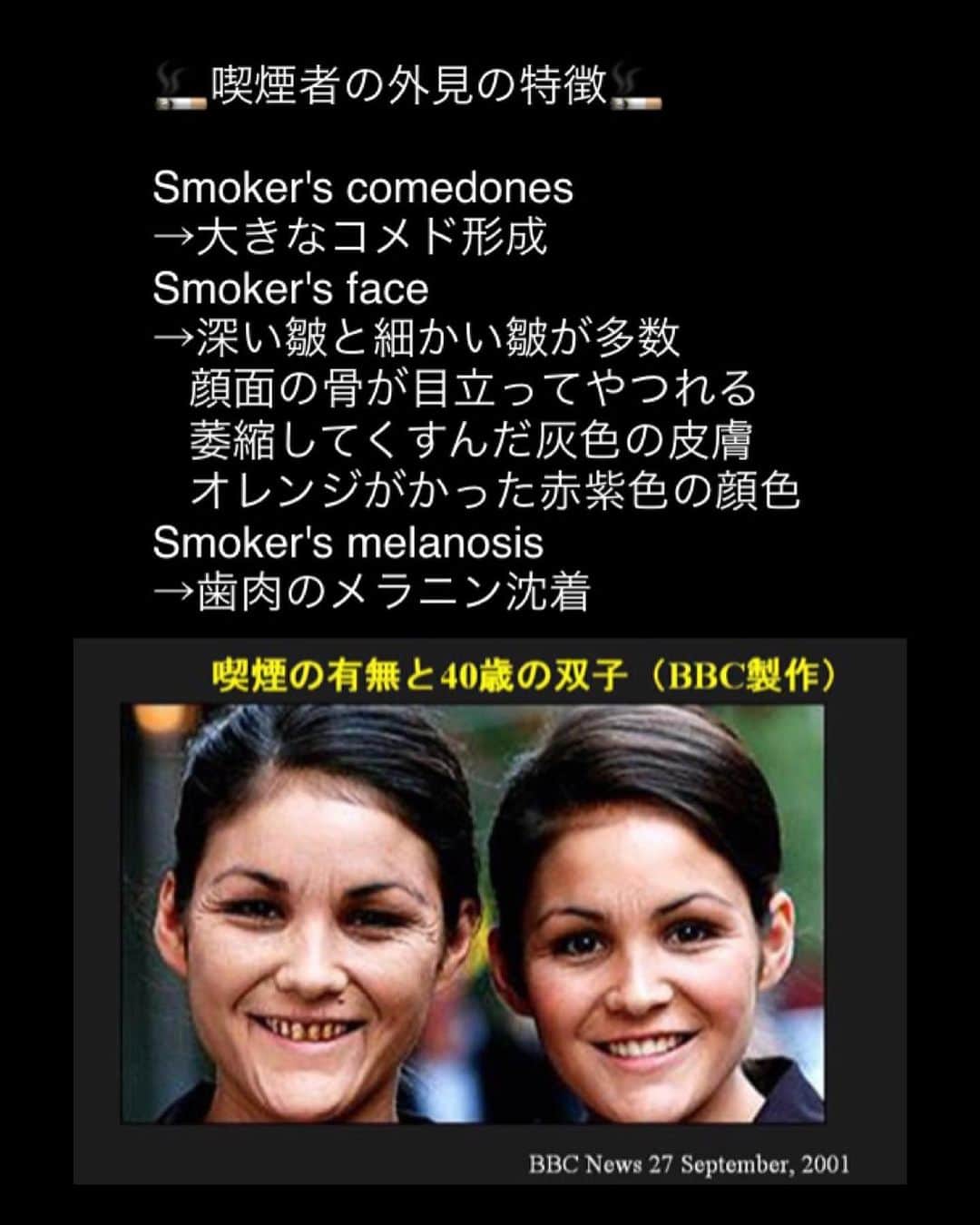 NAOさんのインスタグラム写真 - (NAOInstagram)「* 昔よりはタバコが人体に及ぼす影響も認知されるようになり、呼吸器内科の先生による禁煙外来をやっている病院も多くなりましたね。 今回はタバコについてサラッと触れてみました🚬 主流煙よりと副流煙の方が有害物が多いこともあるんですよ。 周りの大切な人を守るためにも禁煙に興味を持ってもらえたら嬉しいです✨ * ちなみに写真はドバイで初めてシーシャを体験した画像です笑 * #美容 #タバコ #smoker #tabacco #ドバイ #dubai #shisha #シーシャ #肌質改善 #女医 #女医stagram #禁煙 #美容好きな人と繋がりたい #綺麗になりたい #健康 #医師 #医療 #health #doctor #ffl #followｍe #followforlike #フォローミー #ドバイ旅行」2月2日 19時01分 - dr_nao_0415