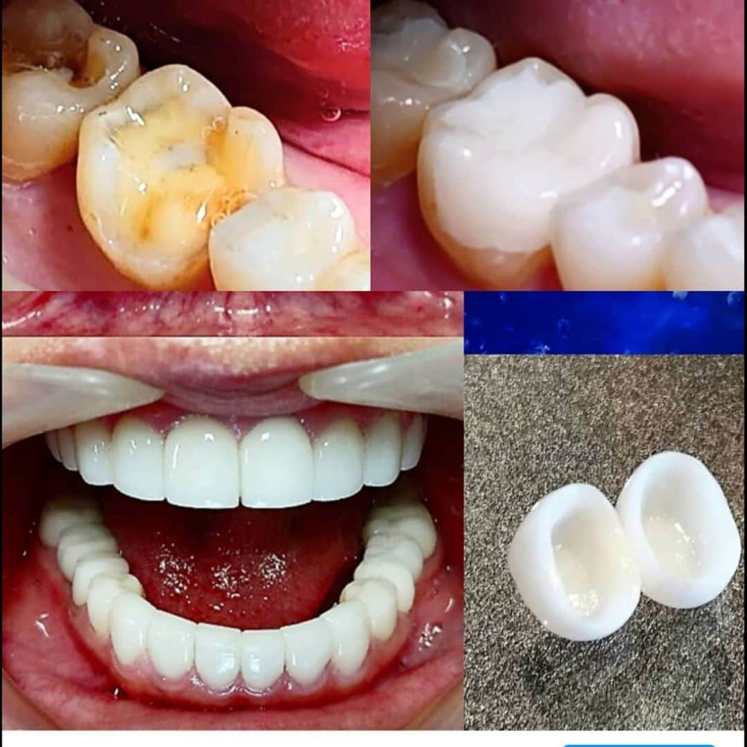 五十嵐一誠さんのインスタグラム写真 - (五十嵐一誠Instagram)「写真上の部分的セラミックインレーの料金は  手前の大が１本25,000円 奥の小が１本23,000円  基本的治療費 部分的銀歯外し１本  1,000円 虫歯除去、形成、１本5,000円  神経の治療などは別料金になります (全て税抜き価格です)  下の写真のジルコニアセラミッククラウンの料金は  １本 10万円(税抜き)  基本治療費 形成、型取り、仮歯、 １本 15,000円(税抜き)  歯の状態によって別途治療費がかかります  セラミックインレーのメリット  １.見た目が自然で綺麗 ２.強度と耐久性に強く変色しにくい  です ３.セメントとの相性が良い ４.白くクリアなので虫歯を見つけやすい  デメリット １.金属と比較すると割れることがある ２.高い技術が必要  ジルコニアセラミッククラウンのメリット  １.強度と耐久性、審美性に優れている ２.金属を使用しないので金属アレルギーや身体に安全  デメリット １.金属と比較すると割れることがある ２.高い技術が必要  五十嵐歯科クリニック六本木は 何故そんなに安めの料金設定なのか？  という質問が多数ありますので お答えします  安かろう悪かろうな 安いけど品質もそれなりでは ただ単に安いだけになってしまいます  僕が絶対的に信頼する 高度な技術を持つ技工士が 僕の厳重な監修のもとに許可された 製作物だけをお客さまにお届けしてます CADCAMのような機械が製作する セラミックとは全く違う １本１本丁寧に手作業で作りあげた 極めて高品質なセラミックです  僕のコンセプトは 最高の品質をリーズナブルな価格で なんです  僕はたくさんの日本人に 銀歯のない海外にも誇れる綺麗な白い歯になって欲しいと思ってます  アフターコロナのこれからの時代は 高品質なものを薄利多売が主流に なると思います  本当に良いものを適正な価格で  五十嵐歯科クリニック六本木は それを実施してます  お問い合わせは電話で  お待ちしてます  #セラミック#銀歯#虫歯#歯医者 #メタルフリー#金属アレルギー #ジルコニア#白い歯#審美歯科 #美容#整形#CADCAM#経営 #歯科#アフターコロナ#コロナ」2月28日 12時53分 - superdentist5