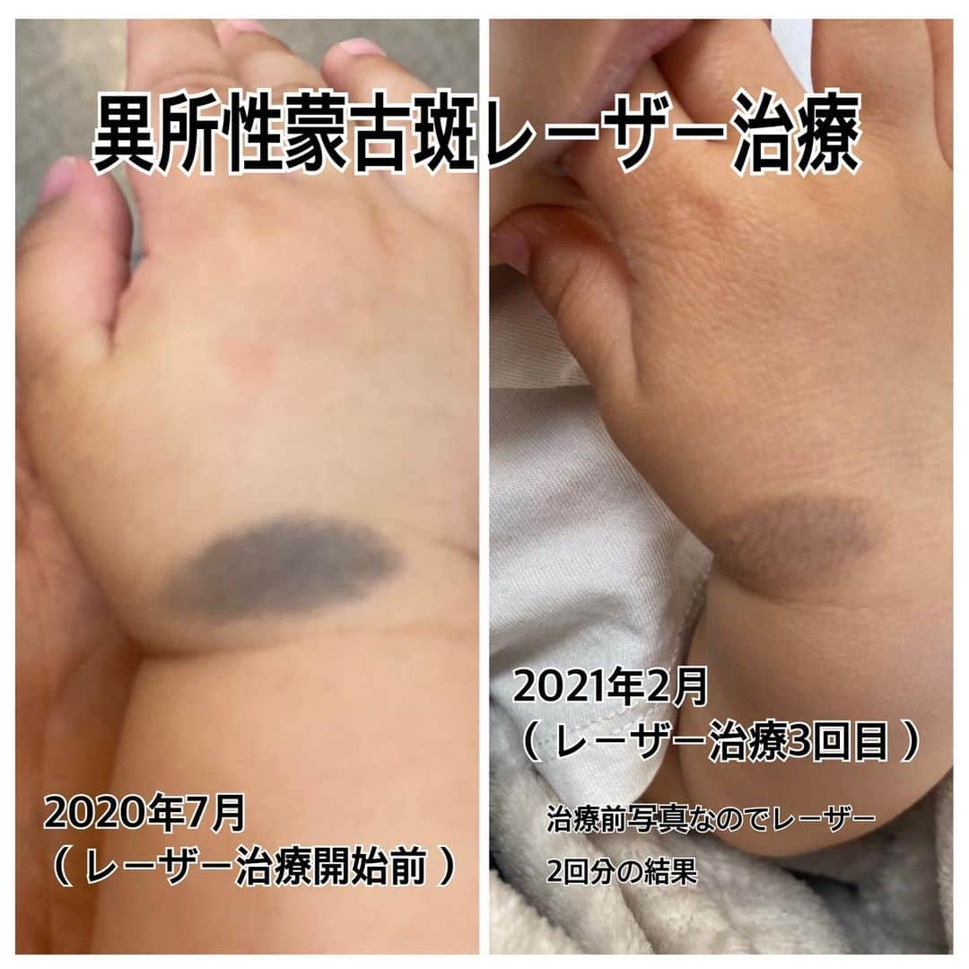 伊藤春香さんのインスタグラム写真 - (伊藤春香Instagram)「異所性蒙古斑の3回目のレーザー治療に﻿ 行ってきました。詳しくはブログにも✍️﻿ ﻿ 治療の情報を探している方の﻿ 役に立てばいいな～と思い、﻿ ﻿ 検索にひっかかりやすいように﻿ インスタにも載せておきます。﻿ ﻿ 2枚目が、レーザー治療前と、﻿ 今朝（レーザー2回照射後）の比較写真です。﻿ ﻿ #異所性蒙古斑 #1歳5ヶ月 #1歳育児 #育児情報交換 #ママライフ #育児記録 #レーザー治療 #ピコレーザー #皮膚科 #蒙古斑 #赤ちゃんのいる生活 #1歳男の子」2月28日 19時21分 - ha_chu