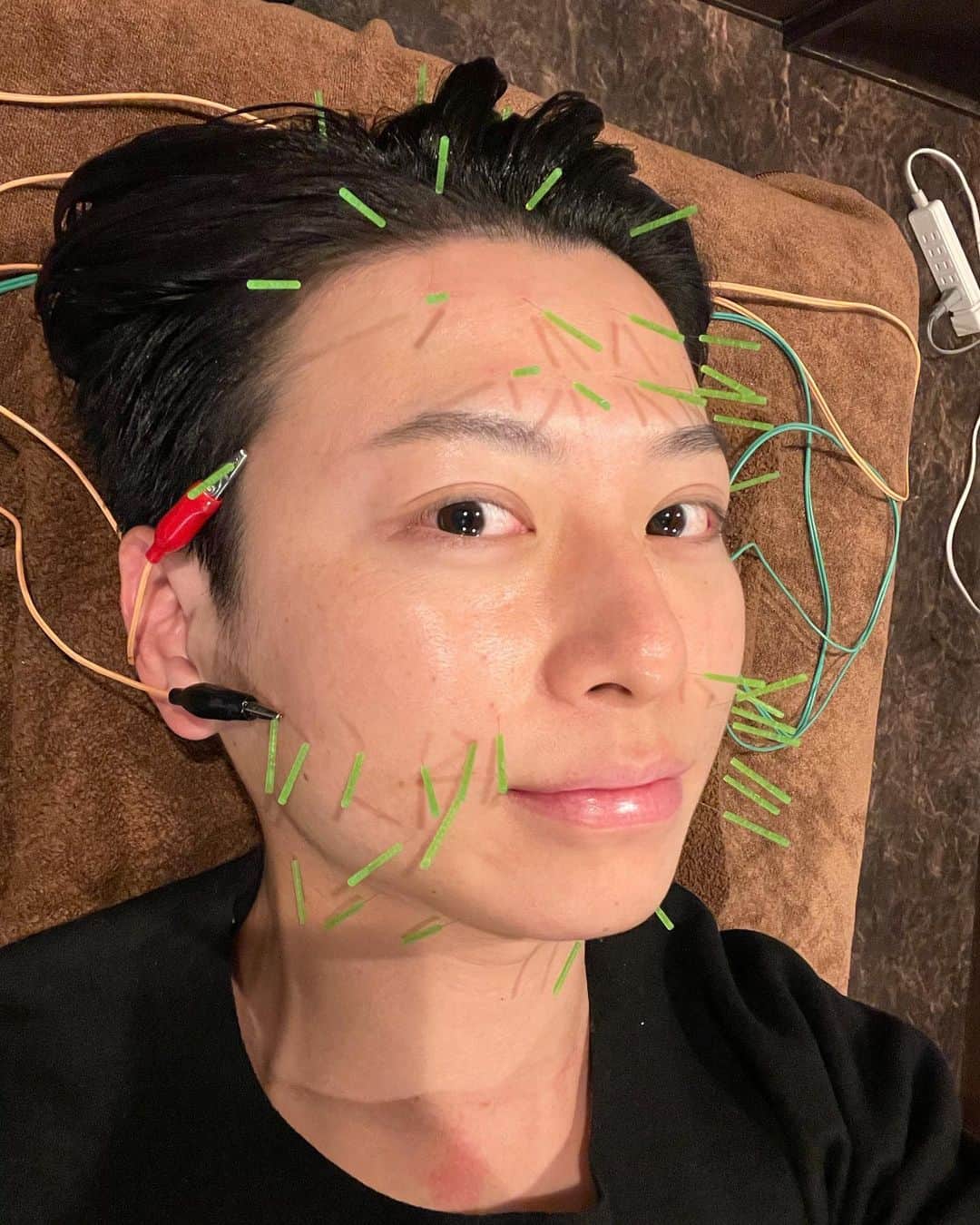 のインスタグラム：「今日はオーディション前に美容鍼と小顔フェイシャルを受けに行ってきました✨  美容鍼って顔のリフトアップやムクミとりだけじゃなく、血行が良くなるのでクマがきえたり、細胞を活性化させ、コラーゲンを生み出す力を引き出す効果があると言われているんです✨  なので術後、肌に弾力がまして、ツヤも出たような感じがします✨  before after の写真を観て頂けると分かると思いますが、頬の1番高い位置が上がって眉毛も上がっています✨  日頃から顔の筋トレをしている僕でさえ、さらにリフトアップしたので、美容鍼の効果に驚きです✨  気になった方は是非行って実感してみてくださいね✨  今日僕が行ったサロンはこちら✨ @ryuken.gram   僕のインスタを見たよって予約すると✨  美容鍼　8.800円→5.500円 美容鍼とフェイシャルのセット 13.000円→9.980円  になるそうです✨お得✨  大切な記念日の前とかに行くといいかもしれませんね✨  加藤先生ありがとうございました✨  ※すべて加工なしの写真と動画です✨  #顎尖る　#美容鍼灸サロン　#隆健鍼灸整骨院　#美容鍼　#フェイシャル　#個室サロン　#酸素カプセル　#メンズ美容鍼　#美容男子　#瀬戸口弘樹 #メンズビューティー　#メンズ美容　#身嗜み　#美肌　#美肌ケア　#リフトアップ　#若返り　#アラフォー　#美容好きな人と繋がりたい　#スキンフルエンサー　#skinfluencer #japan  #美容男子と繋がりたい　#美容オタク  #アンチエイジング　#美容」