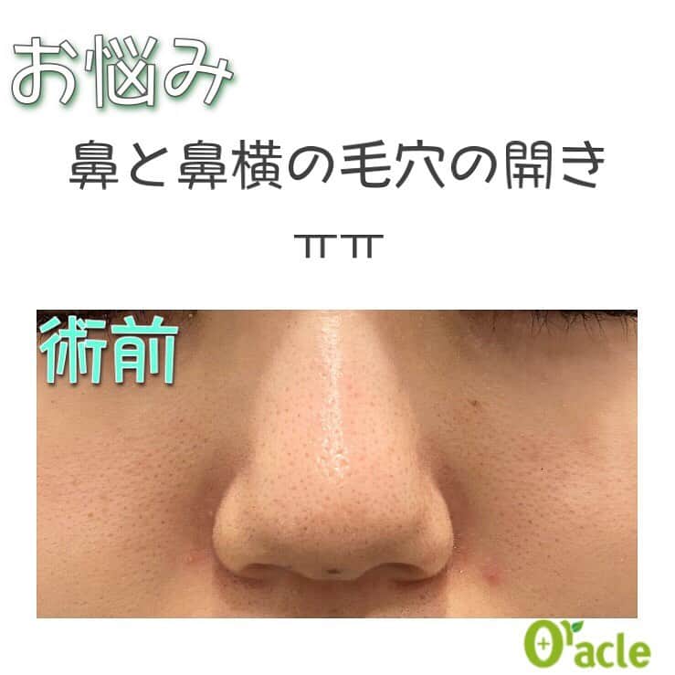 オラクル美容皮膚科東京新宿院さんのインスタグラム写真 - (オラクル美容皮膚科東京新宿院Instagram)「OKIKUフラクセルレポ📝﻿ ﻿ 鼻と鼻横の毛穴の開きがきになっており、﻿ 先日2回目のフラクセルを受けてきました🌟﻿ ﻿ ～～～～～～～～～～～～～～～～﻿ 📌術前：鼻と鼻横の開き毛穴がきになる～😭﻿ 📌術中：フラクセルは麻酔をする施術なので痛みはほとんどないです＾＾﻿ ちょっとひりひりする痛さです☝﻿ 📌施術直後：直後はレーザーを当てたところが白く浮きだったようになります。﻿ この白っぽいのが後でかさぶたになっていきます！﻿ ⇩﻿ 📌施術当日、顔の赤みが増してきました😳痛みは少しひりひりする程度です！﻿ 当日は成長因子がたっぷり配合された『リジェスキン』のクリーム2種類とSRSマスクでダウンタイムの軽減を狙います⚡フラクセル後はかな～り赤みが出るのでこちらのコスメでのケアは必須です👍﻿ 私はSRSマスクを当日1回使用、リジェンスキンクリームを1週間使い続けました✨﻿ ﻿ 📌翌日：SRSマスクとリジェンスキンクリームのおかげで赤みはほどんど消えました♥﻿ このかさぶたが1週間ほどかけてポロポロはがれていきます。﻿ 📌2日目～かさぶたがすこーしづつはがれていきました！﻿ ⇩﻿ 📌9日後：輪郭部分にうっすらかさぶたが残っていますが化粧で隠れる程度で、マスクもするので見えることはありません✨﻿ 鼻横の毛穴が結構引き締まったように感じます！鼻の毛穴も気持ち引き締まりました🥺💗﻿ ﻿ やっぱりフラクセル凄いです、、！﻿ アクティブな治療なのでダウンタイムがありますが、SRSマスクとリジェンスキンクリームでケアをしっかり行えばダウンタイムも軽減される&マスクで見えないのでそこまで心配しなくても大丈夫だと思いました！﻿ まだまだ自分の中で完全体ではないのでこれからもフラクセル続けていきたいです🥰﻿ ～～～～～～～～～～～～～～～～﻿ ﻿ 毛穴の開きでお悩みの方にぜひ試していただきたいです💓﻿ ﻿ 【料金】﻿ 部分1回　7,200円﻿ 顔全体1回　19.800円﻿ ※税抜き表示﻿ ﻿ 🔵ダウンタイム中使用した”リジェンスキン”[新宿限定]﻿ ・SRSセルファクリーム➡ヒト臍帯血幹細胞順化培養液を10,000PPM配合。なんとSRSマスクメディより2倍の配合なんです😳﻿ 50m 9,800円(税抜)﻿ ﻿ ・SRSダーマクリーム➡防腐剤なし、ノンアルコールで自然由来の肌の保護や保湿メインのクリーム。アミノ酸誘導体で細胞を保護しアンチエイジング効果をもたらします。﻿ 30m 9,800円(税抜)﻿ ﻿ ▪️▫️▪️▫️▪️▫️▪️▫️▪️▫️﻿ ﻿ 🇯🇵オラクル美容皮膚科🇰🇷﻿ 📍東京新宿院﻿ 新宿3丁目19-4 MLJ新宿8階﻿ ﻿ 📍名古屋院﻿ 名古屋市中区錦3丁目24-4﻿ サンシャイン栄5階﻿ ﻿ 【専門】﻿ ニキビ（跡）／毛穴／シミ／しわ／たるみ／痩身／アンチエイジング／美白美肌治療全般／ブライダル相談／メンズ美容﻿ ﻿ 🗝完全予約制﻿ 👠土日祝日も診療﻿ ﻿ 【予約方法】﻿ ☎0120-905-696﻿ ⏰9:00～21:00［年中無休］﻿ ﻿ LINE、メール24時間📧﻿ LINE🆔 @oracle.jp ﻿ 📩HPメールフォームよりお願いいたします﻿ ﻿ ﻿ ▪️▫️▪️▫️▪️▫️▪️▫️▪️▫️﻿ ﻿ #オラクル美容皮膚科 #オラクル ﻿ #oracle #韓国美容 #美容皮膚科 ﻿ #皮膚科 #美容 #コラーゲン #毛穴レス肌 #陶器肌 #美容マニア  #毛穴対策 #弾力 #ハリ #美白 #毛穴レス #毛穴撫子 #일본피부과 #오라클피부과 #毛穴の開き #毛穴ケア #美肌 #美肌ケア #肌管理 #韓国美容皮膚科 #毛穴 #レーザー治療 #フラクセルレーザー #フラクセル #オラクル毛穴症例」2月8日 16時27分 - oraclejp