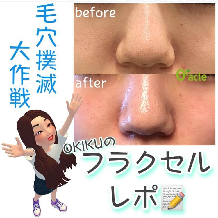 オラクル美容皮膚科東京新宿院さんのインスタグラム写真 - (オラクル美容皮膚科東京新宿院Instagram)「OKIKUフラクセルレポ📝﻿ ﻿ 鼻と鼻横の毛穴の開きがきになっており、﻿ 先日2回目のフラクセルを受けてきました🌟﻿ ﻿ ～～～～～～～～～～～～～～～～﻿ 📌術前：鼻と鼻横の開き毛穴がきになる～😭﻿ 📌術中：フラクセルは麻酔をする施術なので痛みはほとんどないです＾＾﻿ ちょっとひりひりする痛さです☝﻿ 📌施術直後：直後はレーザーを当てたところが白く浮きだったようになります。﻿ この白っぽいのが後でかさぶたになっていきます！﻿ ⇩﻿ 📌施術当日、顔の赤みが増してきました😳痛みは少しひりひりする程度です！﻿ 当日は成長因子がたっぷり配合された『リジェスキン』のクリーム2種類とSRSマスクでダウンタイムの軽減を狙います⚡フラクセル後はかな～り赤みが出るのでこちらのコスメでのケアは必須です👍﻿ 私はSRSマスクを当日1回使用、リジェンスキンクリームを1週間使い続けました✨﻿ ﻿ 📌翌日：SRSマスクとリジェンスキンクリームのおかげで赤みはほどんど消えました♥﻿ このかさぶたが1週間ほどかけてポロポロはがれていきます。﻿ 📌2日目～かさぶたがすこーしづつはがれていきました！﻿ ⇩﻿ 📌9日後：輪郭部分にうっすらかさぶたが残っていますが化粧で隠れる程度で、マスクもするので見えることはありません✨﻿ 鼻横の毛穴が結構引き締まったように感じます！鼻の毛穴も気持ち引き締まりました🥺💗﻿ ﻿ やっぱりフラクセル凄いです、、！﻿ アクティブな治療なのでダウンタイムがありますが、SRSマスクとリジェンスキンクリームでケアをしっかり行えばダウンタイムも軽減される&マスクで見えないのでそこまで心配しなくても大丈夫だと思いました！﻿ まだまだ自分の中で完全体ではないのでこれからもフラクセル続けていきたいです🥰﻿ ～～～～～～～～～～～～～～～～﻿ ﻿ 毛穴の開きでお悩みの方にぜひ試していただきたいです💓﻿ ﻿ 【料金】﻿ 部分1回　7,200円﻿ 顔全体1回　19.800円﻿ ※税抜き表示﻿ ﻿ 🔵ダウンタイム中使用した”リジェンスキン”[新宿限定]﻿ ・SRSセルファクリーム➡ヒト臍帯血幹細胞順化培養液を10,000PPM配合。なんとSRSマスクメディより2倍の配合なんです😳﻿ 50m 9,800円(税抜)﻿ ﻿ ・SRSダーマクリーム➡防腐剤なし、ノンアルコールで自然由来の肌の保護や保湿メインのクリーム。アミノ酸誘導体で細胞を保護しアンチエイジング効果をもたらします。﻿ 30m 9,800円(税抜)﻿ ﻿ ▪️▫️▪️▫️▪️▫️▪️▫️▪️▫️﻿ ﻿ 🇯🇵オラクル美容皮膚科🇰🇷﻿ 📍東京新宿院﻿ 新宿3丁目19-4 MLJ新宿8階﻿ ﻿ 📍名古屋院﻿ 名古屋市中区錦3丁目24-4﻿ サンシャイン栄5階﻿ ﻿ 【専門】﻿ ニキビ（跡）／毛穴／シミ／しわ／たるみ／痩身／アンチエイジング／美白美肌治療全般／ブライダル相談／メンズ美容﻿ ﻿ 🗝完全予約制﻿ 👠土日祝日も診療﻿ ﻿ 【予約方法】﻿ ☎0120-905-696﻿ ⏰9:00～21:00［年中無休］﻿ ﻿ LINE、メール24時間📧﻿ LINE🆔 @oracle.jp ﻿ 📩HPメールフォームよりお願いいたします﻿ ﻿ ﻿ ▪️▫️▪️▫️▪️▫️▪️▫️▪️▫️﻿ ﻿ #オラクル美容皮膚科 #オラクル ﻿ #oracle #韓国美容 #美容皮膚科 ﻿ #皮膚科 #美容 #コラーゲン #毛穴レス肌 #陶器肌 #美容マニア  #毛穴対策 #弾力 #ハリ #美白 #毛穴レス #毛穴撫子 #일본피부과 #오라클피부과 #毛穴の開き #毛穴ケア #美肌 #美肌ケア #肌管理 #韓国美容皮膚科 #毛穴 #レーザー治療 #フラクセルレーザー #フラクセル #オラクル毛穴症例」2月8日 16時27分 - oraclejp