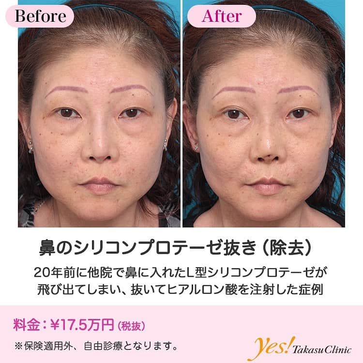 高須クリニックのインスタグラム：「👨🏻‍⚕️高須幹弥医師からのコメント✨⠀ 50代女性の患者様で、約20年前に他院で鼻にL型シリコンプロテーゼを入れていました。 数日前から鼻先の皮膚を突き破ってプロテーゼが飛び出ている状態であったらしく、来院時には破れた皮膚の奥からは膿が出て、悪臭を放っていました。 このまま放置すると、どんどん破れた皮膚の穴は拡がって、感染がひどくなっていくので、緊急手術でプロテーゼを抜くことになりました。 手術は局所麻酔を行い、鼻の穴の中を切開し、プロテーゼを抜きました。 プロテーゼを抜いたため、鼻根部から鼻背にかけて低くなり、また、鼻先皮膚の穴の空いた部分は塞がりはしましたが、拘縮して、鼻先が上に上がってしまいました。 プロテーゼを抜いて2ヶ月後、患者様の希望で、ヒアルロン酸を注射しています。 ---------------------------------------------------- 🌈料金✨⠀ ●鼻のシリコンプロテーゼ抜き（除去） ¥175,000【東京、横浜、名古屋、大阪】 ---------------------------------------------------- ⚠️リスク・副作用・合併症✨⠀ ●鼻のシリコンプロテーゼ抜き（除去） 腫れ（術後） --------------------------------------------------- 😊施術についての詳細✨⠀⠀ https://www.takasu.co.jp/photo/prosthesis_removal01.html ---------------------------------------------------- 📞ご予約・お問い合わせ✨⠀ 0120-5587-10⠀ https://www.takasu.co.jp/cgi-bin/form/contact.cgi ※症例写真や施術に関するご質問なども上記までお願い致します。 ---------------------------------------------------- #鼻のシリコンプロテーゼ抜き #鼻整形 #プロテーゼを抜きたい  #皮膚 #美容 #美肌 #エイジングケア #美容整形 #美容外科 #美容クリニック #美容好き #美容皮膚科 #モニター #モニター募集 #高須クリニック #高須クリニック名古屋 #高須幹弥 #整形したい #プチ整形 #症例 #症例写真 #可愛くなりたい #可愛い #美人」