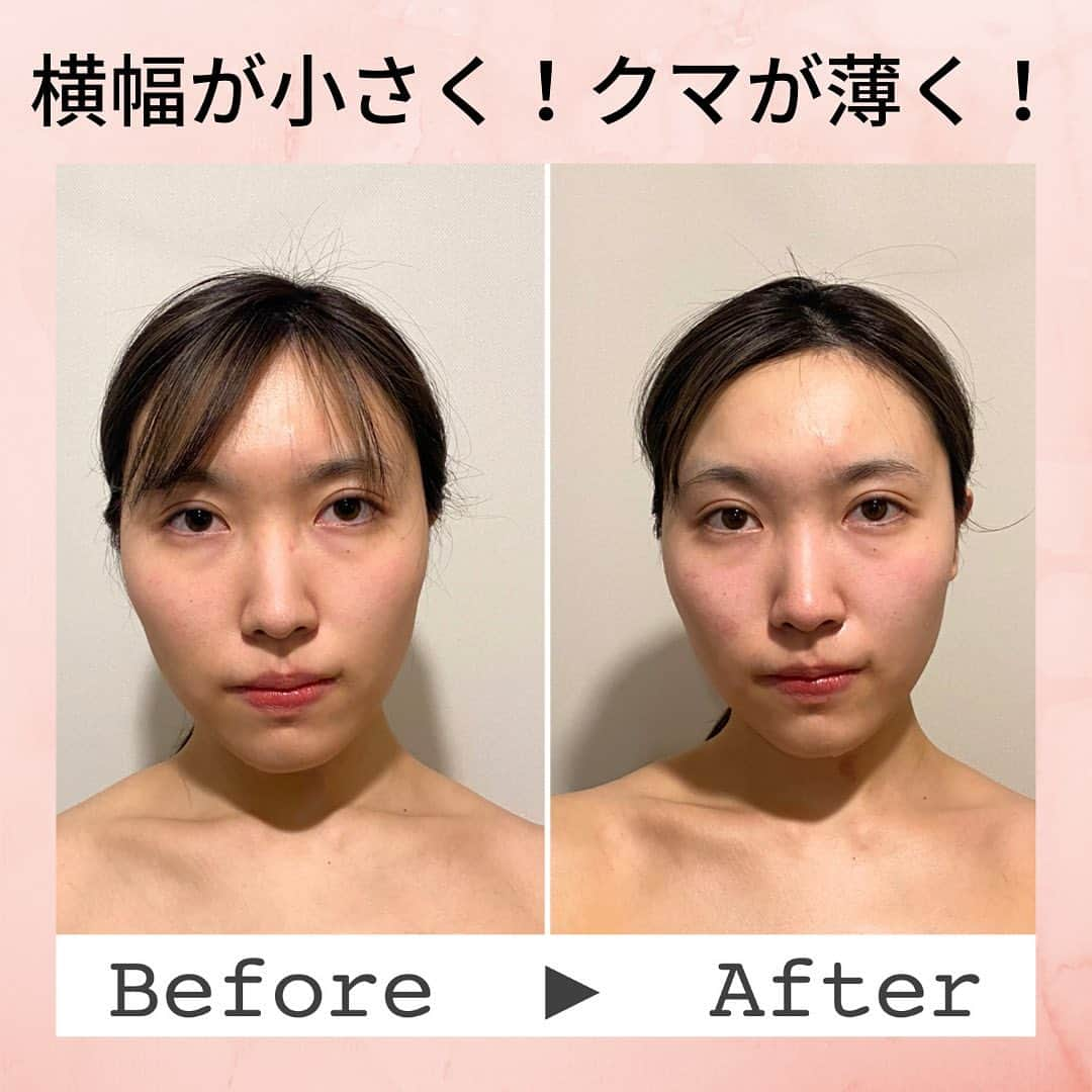 Eternal Total Beauty Salonのインスタグラム：「【ビフォーアフター】  こちらは1回での変化です✨  縦にもスッキリし、ハチ張りも目立たなくなりました🥺  頭皮の施術も行っています！  ほとんどの方がお休みになられているくらい💤　 起きたらお顔が変わっていますよ🥰  日によっての不調な箇所なども伺いながら一人一人に合わせて施術させて頂いております☺️  ＊＊＊＊＊＊＊＊＊＊＊＊＊＊  恵比寿駅西口徒歩4分♪ インディバエステ/小顔・痩身  営業時間　11:00〜21:00(19:00最終受付)  定休日　不定休  Tel 0364163830 お電話はつながり難い事が多いのでDMもしくはトップページの予約サイトから🙇‍♀️ 【@beautylian.111】  ＊＊＊＊＊＊＊＊＊＊＊＊＊＊  #インディバ  #インディバエステ  #インディバサロン  #インディバ 東京 #小顔東京 #小顔 #コルギ  #小顔矯正 #ビフォーアフター #ビフォーアフター写真  #セルライト除去  #免疫力を高める  #結果の出るサロン　 #顔の幅が狭くなる  #えらはり改善  #エラ張り解消  #左右差が整います  #むくみ防止  #浮腫み解消  #顔痩せ効果  #冷え性改善  #体質改善 #高周波 #美と健康 #リフトアップ #エニシーグローパック正規取扱店」