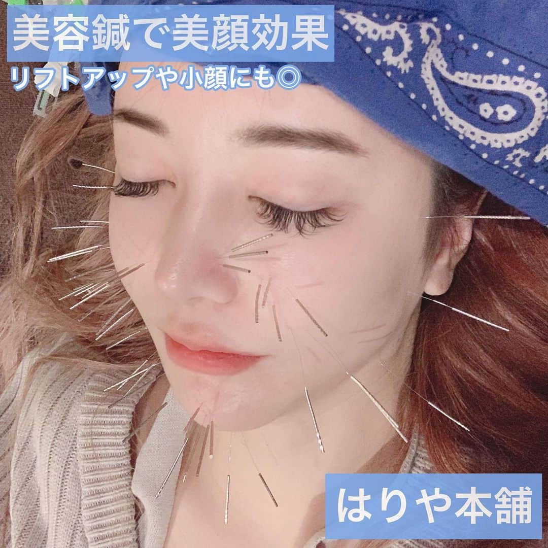 吉川ちえさんのインスタグラム写真 - (吉川ちえInstagram)「【⭐美容鍼⭐】 . 1年半前からたびたび通ってる 美容鍼を最近復活しました☺️✨ . 骨切りのダウンタイムで口周り💋が 麻痺してるので鍼治療受けてるけど 本当に最近調子が良い～🙈‼️ . 鍼でも電気を流してくれるので 普段使われない顔の筋肉💪やツボを 刺激⚡️してくれて顔がすっきりする～🦋 刺激されることでたるみ防止や リフトアップ効果があるよ☺️❤️ . 美容鍼は( @hariyahonpo )で 受けてるよー🙈💕 鍼と一緒に吸玉もやってる✨ 肩こりや腰痛が和らぐから良き🙆🏻 . #美容鍼 #鍼治療 #鍼 #ダウンタイム」2月9日 22時18分 - yoshikawachie_16