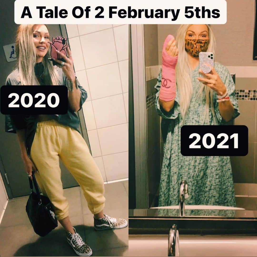 カンディー・ジョンソンのインスタグラム：「Airport bathroom Selfie VS pre-surgery bathroom selfie: 1. FEB 5, 2020 - I hadn’t even heard the name Covid yet and was in the airport bathroom taking this picture before boarding a flight for the launch of my PopGlam hair care line with @ogx_beauty - first going to Canada for their launch then going to NYC. I had no idea this would be my last time going on a plane for a long time, being out in public without a mask and not realizing how extra grateful I should be for going to eat indoors in NYC. 2. February 5, 2021...none of my “fitted” clothes, including jeans, from February 2020, fit me anymore. I’ve become inseparable BFFs with my house. I also had an accident (if you missed it, there’s a link in my bio to a youtube video) with a huge glass bowl, that broke and the weight of the heavy bowl went down in my hand and severed a nerve. At the hospital they didn’t realize that & stitched my hand back up after making sure it didn’t hit the bone & needed to stop the bleeding. Nerve damage pain began 3-4 days later & thanks to a follower who DM’ed to get to a hand specialist ASAP.  THE PAIN WAS UNBEARABLE- every second of the day, it felt like someone was sawing my thumb off & hammering a nail into the top of my thumb, bursting through the skin then pounding it deep into my bone. Enter @drcohenhandsurgeon (one of the best hand surgeons in the world)...with nerve damage you need surgery fast to save the nerve.  I don’t want to gross anyone out with the pics here, but the nerve is the size of a spaghetti noodle and the thread @drcohenhandsurgeon used was thinner than a human hair, to microscopically reattach my severed nerve. Also I’ve never had surgery (not even for my leg accident- it was just lots of sutures), never gone under anesthesia and @drcohenhandsurgeon & his entire surgical staff were the sweetest! My nerve is still angry & traumatized & feels crazy  but he reattached it. And I’ve been doing therapy treatments and will be wearing “Shiela” my brace for a while, so welcome her in all upcoming posts!😂 I can’t thank you enough for all your prayers...those who watched my stories know what I was going through🥺 Thank you all for loving me & your prayers❤️🙏」