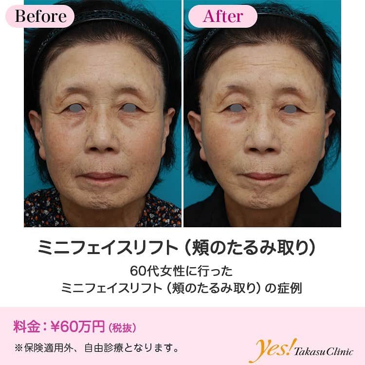高須クリニックのインスタグラム：「👨🏻‍⚕️高須幹弥医師からのコメント✨⠀ 60代女性の患者様で、顔全体のたるみの改善を希望して来院されました。 切る治療、切らない治療を一通り説明させていただいたところ、「1週間くらいはれてもかまわない」「切ることに抵抗はない」「どうせ同じお金をかけるなら、少しでもたくさんエイジングケア効果がでたほうがいい」ということだったので、切る治療をすることになりました。 まず、頬、フェイスライン、首のたるみを改善したいという御要望だったので、フルフェイスリフトをすることをご提案しましたが、予算の都合でミニフェイスリフト（頬のたるみ取り）をすることになりました。 術後は頬、フェイスラインのたるみが改善し、綺麗な輪郭になりました。 首のたるみも軽度改善しました。 ---------------------------------------------------- 🌈料金✨⠀ ●ミニフェイスリフト（頬のたるみ取り） ¥600,000【東京、横浜、名古屋、大阪】 ---------------------------------------------------- ⚠️リスク・副作用・合併症✨⠀ ●ミニフェイスリフト（頬のたるみ取り） 切開した周辺の腫れ（術後） 仕上がりのわずかな左右差（完璧なシンメトリーは不可） 傷跡が肥厚性瘢痕やケロイドになる可能性 感覚が鈍くなる可能性 手術後の血腫 --------------------------------------------------- 😊施術についての詳細✨⠀⠀ https://www.takasu.co.jp/photo/minilift18.html ---------------------------------------------------- 📞ご予約・お問い合わせ✨⠀ 0120-5587-10⠀ https://www.takasu.co.jp/cgi-bin/form/contact.cgi ※症例写真や施術に関するご質問なども上記までお願い致します。 ---------------------------------------------------- #ミニフェイスリフト #頬のたるみ取り #頬のたるみ改善 #フェイスラインのたるみ改善 #綺麗な輪郭  #皮膚 #美容 #美肌 #エイジングケア #美容整形 #美容外科 #美容クリニック #美容好き #美容皮膚科 #モニター #モニター募集 #高須クリニック #高須クリニック名古屋 #高須幹弥 #整形したい #プチ整形 #症例 #症例写真 #可愛くなりたい #可愛い #美人」