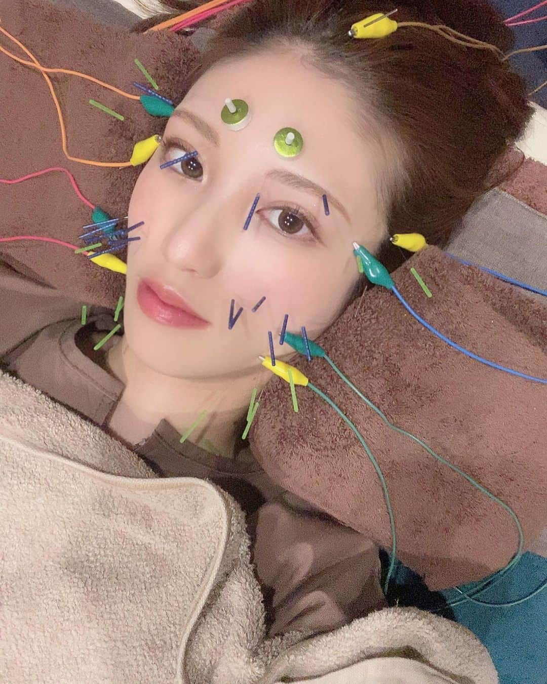 阿野いずみさんのインスタグラム写真 - (阿野いずみInstagram)「オススメの #美容鍼 ♡ . 雑誌などでも紹介されているトータルサロン｢Salon de 美的ラボ｣ @salon.bitekilab さんへお肌のメンテナンスへ🏃‍♀️ . 久々の美容鍼で緊張したけど、 @moe_._._moe さんの丁寧な施術でリラックスして、施術を受けてきました☺️ . 美容鍼は自己治癒力を引き出して、小顔効果・リフトアップ効果・美肌効果など嬉しい効果がたくさん◎ . 私の顔は、肌の血色が良くなってくすみが消えるのが分かりやすい👏 . 美的ラボさんは、美容鍼の他にもフェイシャルやバストや脱毛など施術が充実していて、すごくオススメです🥺❤️ . ご予約の際に【阿野いずみの紹介】と伝えると、初回半額＋お好きなオプションプレゼントになります🤝 . . . #salonde美的ラボ #美的鍼 #美容鍼 #痛くない鍼 #小顔効果 #つや肌 #くすみ #たるみ #むくみ #乾燥対策 #美容鍼灸 #福岡 #大名」2月11日 19時51分 - izumi_ano