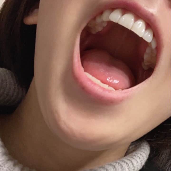伊藤えみさんのインスタグラム写真 - (伊藤えみInstagram)「先日歯医者さんの定期検診で歯磨き上手って褒められたから、別に誰も得しない私の歯の写真載せておくね。  #歯 #歯科 #口の中  #歯医者さん #虫歯ゼロ #初公開 #求められていない（笑） #迷ったらやる #血迷うこともある」2月12日 17時40分 - itoemi1019