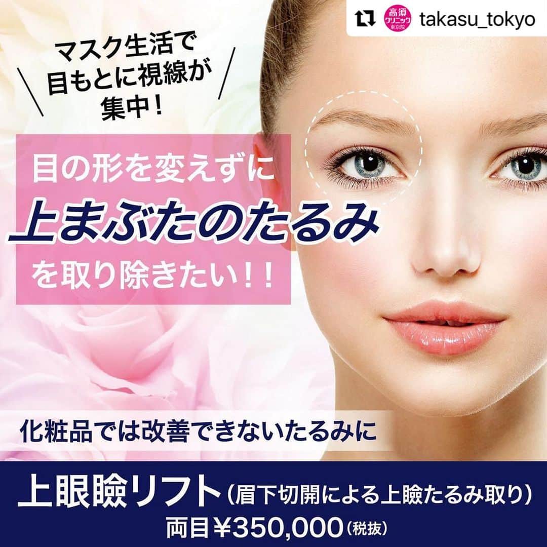 高須クリニックのインスタグラム：「. ━･･━･･━･･━･･━･･━･･━ #Repost @takasu_tokyo ━･･━･･━･･━･･━･･━･･━ 重力の影響で目の周りの筋肉が落ち、皮膚が伸びてしまうことで、化粧品では解決できない“たるみ”になってしまいます。﻿ 伸びてしまった余分な皮膚を取り除く「上眼瞼リフト（眉下切開による上瞼たるみ取り）」は、眉の下で切開を行い、目の上のたるみを引き上げます。﻿ 目の形を変えずにたるみを取るため、元々二重の方は二重のままで、一重の方は一重のままで目の上のたるみを除去します。﻿ ﻿ 【🌿料金】﻿ ●上眼瞼リフト（眉下切開による上瞼たるみ取り）﻿ 片目￥175,000（税抜）﻿ 両目￥350,000（税抜）﻿ ［東京、横浜、名古屋、大阪］﻿ ﻿ 【⚠️副作用・リスク】﻿ ●上眼瞼リフト（眉下切開による上瞼たるみ取り）﻿ 内出血（術後）、仕上がりの左右差（片目ずつ手術をする場合）、仕上がりのわずかな左右差（完璧なシンメトリーは不可）、仕上がりが完璧に自分の理想の形にならないことがある）﻿ ﻿ 【ご予約・お問合せ】 ➿0120-5587-10 ※症例写真や施術に関するご質問なども上記までお願い致します。 ﻿ #高須クリニック　#高須克弥　#美容　#美容整形　#整形手術　#整形　#プチ整形　#整形したい　#美容外科　#美容クリニック　#かわいい　#可愛くなりたい　#綺麗　#綺麗になりたい　#美人　#美容好きな人と繋がりたい　#美容好き　#目元　#まぶた　#二重まぶた　#たるみ　#目周り　#目の上のたるみ　#上まぶた　#上眼瞼リフト　#たるみ改善　#ナチュラル　#eye」