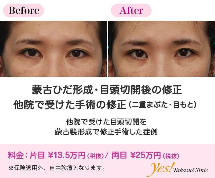 高須クリニックのインスタグラム：「👨🏻‍⚕️高須幹弥医師からのコメント✨⠀ 40代女性の患者様で、6ヶ月以上前に他院で目頭切開を受けていました。 診察させていただいたところ、かなり大きく目頭を切られており、パンチで穴を空けたような不自然な形になっていました。 また、蒙古襞がほとんどなくなるくらい切られていたので、涙丘（眼球の内側のピンク色の粘膜が盛り上がっている部分）が丸見えになってしまっており、寄り目でキツい印象になっていました。 他院で受けた目頭切開の術式は不明ですが、傷跡の状態を見るとW法（内田法）であると思われます。 W法（内田法）は、適応を見極め、正確に行わないと、パンチで穴を空けたような不自然な目頭の形になってしまう上に、W字の汚い傷跡が残ってしまいます。 患者様は自然で優しい感じの目頭に修正してほしいという御要望だったので、蒙古襞形成手術をすることになりました。 手術は逆Z法のデザインで蒙古襞を作り、約2.5mmずつ切り過ぎた目頭を戻しました。 術後は、パンチで穴を空けたような不自然な目頭が程よく尖った自然な目頭になり、適度に涙丘が隠れ、寄り目が解消し、キツい印象もなくなりました。 ---------------------------------------------------- 🌈料金✨⠀ ●蒙古ひだ形成・目頭切開後の修正 片目 ¥135,000 / 両目 ¥250,000【東京、横浜、名古屋、大阪】 ---------------------------------------------------- ⚠️リスク・副作用・合併症✨⠀ ●蒙古ひだ（蒙古襞）形成・目頭切開後の修正 内出血（術後） 仕上がりのわずかな左右差（完璧なシンメトリーは不可） 仕上がりが完璧に自分の理想の形にならないことがある --------------------------------------------------- 😊施術についての詳細✨⠀⠀ https://www.takasu.co.jp/photo/hida06.html ---------------------------------------------------- 📞ご予約・お問い合わせ✨⠀ 0120-5587-10⠀ https://www.takasu.co.jp/cgi-bin/form/contact.cgi ※症例写真や施術に関するご質問なども上記までお願い致します。 ---------------------------------------------------- #蒙古ひだ形成 #自然な目頭 #寄り目改善 #目頭切開後の修正 #他院で受けた手術の修正  #皮膚 #美容 #美肌 #エイジングケア #美容整形 #美容外科 #美容クリニック #美容好き #美容皮膚科 #モニター #モニター募集 #高須クリニック #高須クリニック名古屋 #高須幹弥 #整形したい #プチ整形 #症例 #症例写真 #可愛くなりたい #可愛い #美人」