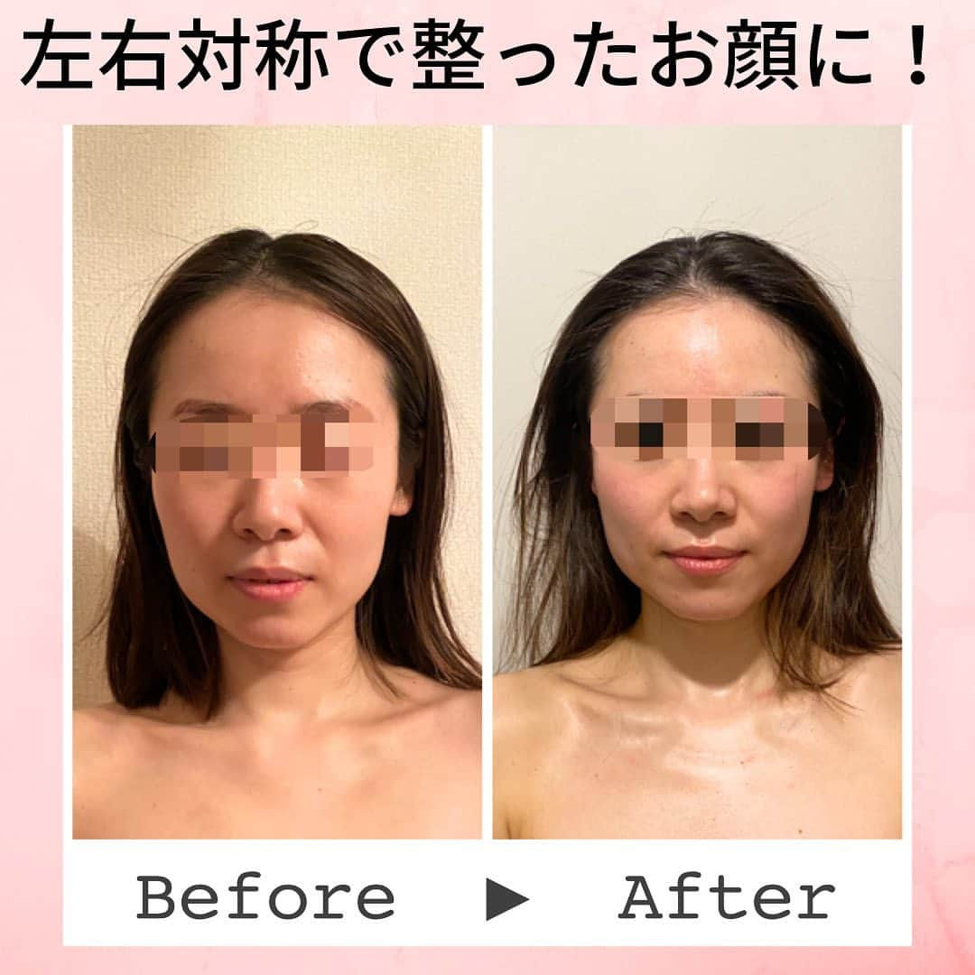 Eternal Total Beauty Salonのインスタグラム：「【ビフォーアフター】  元々美人なお顔立ちから 縦にもスッキリ！左右対称にもなり更に美人度が増しました💕✨  こちらは5回目のビフォーアフターです。  今回は頭の施術も入れたので よりスッキリされました😌  ご本人が気にされていた左右差が整ってとても喜んで下さり、 その姿を見て私もお役に立てた事に嬉しい気持ちでいっぱいです！  今後も通って下さるとの事で🥺 更に腕を磨いていきます💪 ありがとうございます♡  ＊＊＊＊＊＊＊＊＊＊＊＊＊＊  恵比寿駅西口徒歩4分♪ インディバエステ/小顔・痩身  営業時間　11:00〜21:00(19:00最終受付)  定休日　不定休  Tel 0364163830 お電話はつながり難い事が多いのでDMもしくはトップページの予約サイトから🙇‍♀️ 【@beautylian.111】  ＊＊＊＊＊＊＊＊＊＊＊＊＊＊  #インディバ  #インディバエステ  #インディバサロン  #インディバ 東京 #小顔東京 #小顔 #コルギ  #小顔矯正 #ビフォーアフター #ビフォーアフター写真  #セルライト除去  #免疫力を高める  #結果の出るサロン　 #顔の幅が狭くなる  #えらはり改善  #エラ張り解消  #左右差が整います  #むくみ防止  #浮腫み解消  #顔痩せ効果  #冷え性改善  #体質改善 #高周波 #美と健康 #リフトアップ #エニシーグローパック正規取扱店」