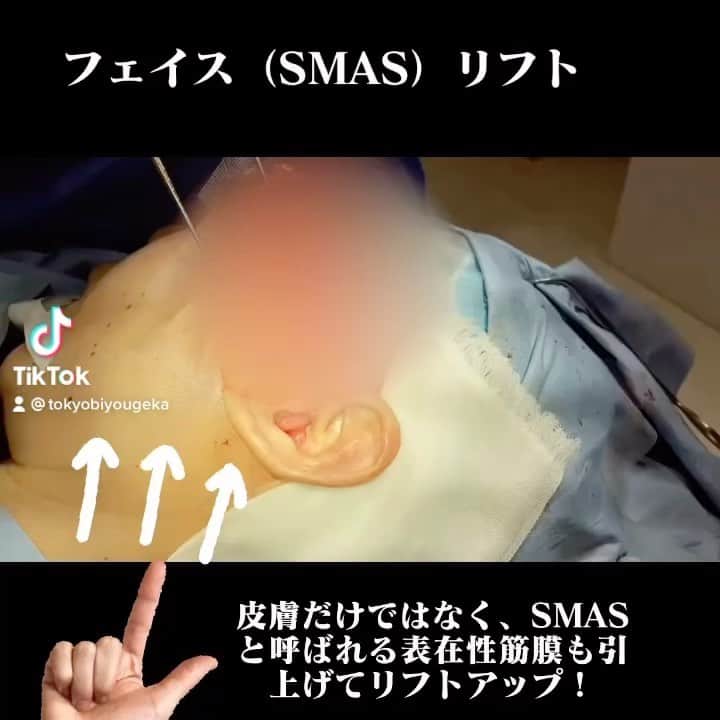 東京美容外科公式のインスタグラム：「筋肉から引上げるSMASリフトアップ 加齢が進むにつれて顔の皮膚だけではなく、筋肉(表情筋)にもたるみが生じます。東京美容外科では、皮膚だけではなくその下にあるSMASと呼ばれる表在性筋膜も引上げるSMAS法を採用しています。SMASをけん引することで、顔全体のたるみと、首のたるみやしわを一挙にリフトアップをすることが可能です。ハイフや糸リフトの予防や治療ではご満足いかなかった方は、是非本格的に引き上がるフェイスリフトのご相談を受けられてみてください☺️  . . . 📞お問い合わせはこちら💁🏼‍♀️ 詳しくはプロフィールのURLから公式サイトへ. ▼フリーダイヤル 0120-658-958 （コールセンター受付時間：9：00～21：00） ▼LINE予約 @ tkc110 ========================= #東京美容外科#美容整形#整形#美活#美容#美容外科#特別外来#他院修正#鼻#豊胸#オンライン#フェイスリフト#ハイフ」