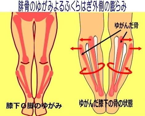 中目黒整体レメディオ 院長　渡邉潤一のインスタグラム：「腓骨（ひこつ）が出っ張りが目立つ方、ふくらはぎが外側に膨らんでいる方は非常に多いですね。特に膝下O脚・XO脚、またO脚の方に特に多い症状です。  腓骨の出っ張りを引き起こしている、腓骨のゆがみの状態ですが、まず腓骨自体が下に下がり、外くるぶしを支点に外側に倒れます。 さらにその状態から内側にねじれるゆがみになります。  また、腓骨が下がったことにより、足首・かかとにゆがみが起こり、より腓骨が下に下がってしまいます。 これは骨盤や股関節がゆがんだことで、体の重心が下がり外側に広がったため、腓骨に負担（体重）がかかり引き起こされます。  腓骨が出っ張りゆがんだ状態になると、ふくらはぎの外側に負荷（体重）がかかります。筋肉はこれを支えようとすることで硬くなります。  筋肉には硬くなるとふくらむという特徴があるので、結果、ふくらはぎの外側の筋肉がふくらみ太くなります。  この腓骨のゆがみ、ふくらはぎのふくらみによって、膝下が曲がっているように見えるのです。 . . それでは、ストレッチをご紹介します。  ストレッチ手順： ①足の小指側を伸ばす側の反対の手で掴み、足首を内側に倒す  ②膝を伸ばしたまま、ゆっくりと掴んでいる手の方向へ引き上げスライドさせる  回数：３０秒～１分 　一日３～５回  注： つま先を持てない、持ち上げたときに膝が曲がってしまう方は、無理に伸ばそうとすると、筋肉を傷めてしまう恐れがありますので、無理せず行ってください。 . . この他の膝下O脚のゆがみ、矯正ストレッチについては、 プロフィールのブログURLから ↓ テーマ別 ↓ ・膝下O脚 XO脚 原因 矯正方法 治し方 ・パーツ別矯正ストレッチ を、ご覧ください。 . . . 💮施術のご案内 中目黒整体レメディオ：骨盤・美脚コース ご予約はHPの予約フォームか、お電話（0357735977）にてご連絡ください。  HPへのリンクは、プロフィール欄の【HP・予約】、ブログ記事下にあります。 . . . #大転子 #大転子矯正 #o脚矯正 #x脚矯正 #膝下o脚 #XO脚 #骨格矯正 #骨盤矯正 #産後骨盤矯正 #下半身太り #下半身痩せ #太もも痩せ #ふくらはぎ痩せ #反り膝  #反り腰 #骨盤の歪み #整体 #中目黒 #レメディオ #姿勢矯正 #中目黒整体レメディオ #整体サロン」