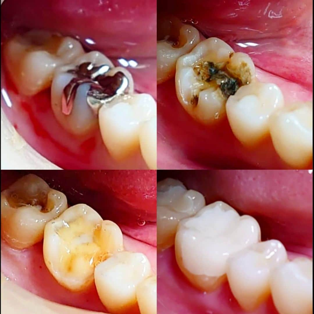 五十嵐一誠さんのインスタグラム写真 - (五十嵐一誠Instagram)「あなたの銀歯は虫歯になってませんか？ 銀歯のまわりがうっすらと 黒っぽく透けてたり 歯との間に隙間や段差がありませんか？  銀歯の下はこうなってる可能性が高いんです  虫歯を削って除去して セラミックで直すと こんなに綺麗に直ります  銀歯は使って年月が経つと 金属が黒ずんできますから 下がこんなに黒くてもわからないんです 銀歯の下が虫歯で柔らかくなって 銀歯がポロっと取れたり 虫歯が神経に到達して痛くならないとわからないですからね  何故、治療した銀歯の下がこんなに 黒く虫歯になるのか？  銀歯の金属は接着剤との相性が良くなくて 接着剤だけが先に溶けて隙間が出来ます そこから虫歯になるんですよ  では、セラミックはどうでしょう  セラミックは下が虫歯で黒くなれば 透けてすぐわかります からに 接着剤との相性が良いので 隙間が出来にくいんです  自分の歯の銀歯をよく観察してみてください  心配な歯がありましたら相談ください 五十嵐歯科クリニック六本木で 検索してくださいね  写真のセラミックの料金は １本25000円(税抜き) 別途治療費がかかります  #セラミック#銀歯#虫歯#白い歯 #審美歯科」2月15日 20時45分 - superdentist5