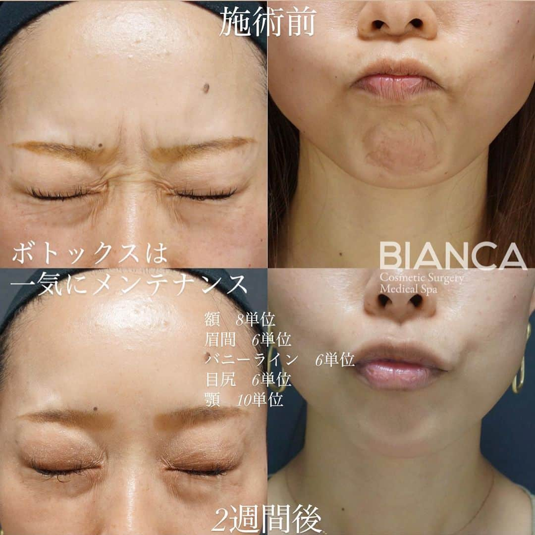 辻沢由有（BIANCA CLNIC 表参道院 院長）さんのインスタグラム写真 - (辻沢由有（BIANCA CLNIC 表参道院 院長）Instagram)「#dryuuボト ▶︎swipeで文字なし症例写真▶︎﻿ 【ボトックスは一気にメンテナンス💉】﻿ ﻿ 気になるシワは一度に治療してあげると、次回のメンテナンスの時期もわかりやすいのでオススメです🥰﻿ ﻿ 上 注入前﻿ 下 注入2週間後﻿ ﻿ ボトックスは、正しい診断と治療が大事👩‍⚕️‼️﻿ ご検討中の方、是非一度カウンセリングに﻿ お越しください😘﻿ ﻿ 🌸額ボトックス💉Botox Vista 8単位﻿ 🌸眉間ボトックス💉Botox Vista 6単位﻿ 🌸バニーラインボトックス💉Botox Vista 6単位﻿ 🌸目尻ボトックス💉Botox Vista 6単位﻿ 🌸顎ボトックス💉Botox Vista 10単位﻿ ﻿ 💴製剤料 600円/単位﻿ 別途 ボトックス施術料 20,000円﻿ ⏳治療時間: 5分﻿ 🗓持続期間: 4〜6ヶ月﻿ 😷腫れ・内出血: 数日程度﻿ ﻿ ﻿ ⚠️ご予約の際は﻿ 『Dr Yuu（辻沢）のインスタ見た』の一言をお願いします👩‍⚕️✨﻿ ﻿ 📍BIANCA CLINIC﻿ ✔︎表参道院﻿ 03-6433-5994﻿ 東京都港区南青山5-11-10  南青山511ビル 2F﻿ ✔︎銀座院﻿ 03-6263-2690 ﻿ 東京都中央区銀座1-5-6 銀座レンガ通り福神ビル 4F﻿ 診療時間 10:00〜19:00﻿ 年中無休（年末年始を除く）﻿ ﻿  ﻿ #美容好き#プチ整形#botoxcapilar #美容好きな人と繋がりたい#美容垢#綺麗になりたい #美容皮膚科 #美容外科 #cosmeticsurgery #plasticsurgery #biancaclinic #ビアンカクリニック #プレ花嫁さんと繋がりたい #followｍe #フォローミー #銀座 #女医 #モニター募集  #dryuuボト#botox #眉間ボトックス #ダイエット #額ボトックス #プチ整形  #イメージチェンジ #ボトックス #ひたいボトックス #女医 #顎ボトックス #目尻ボトックス」2月15日 16時31分 - i_am_yuu__