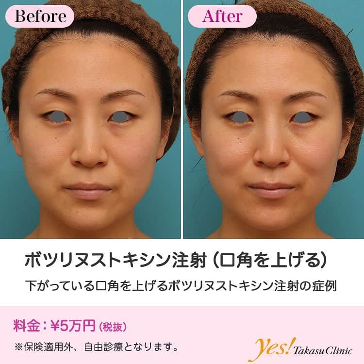 高須クリニックのインスタグラム：「👨🏻‍⚕️高須幹弥医師からのコメント✨⠀ 30代女性の患者様で、口角を上げたいというご要望でした。 診察させていただいたところ、年齢相応に顔全体がたるんでおり、頬もたるんでいるため、口角もつられて下がっていました。 このように、年齢相応に顔がたるんで口角も下がっている場合は、切るフェイスリフトやイタリアンリフトなどの糸のリフトアップ手術が効果的なことが多いですが、患者様は、「まずは手軽にできるボツリヌストキシン注射でやってみたい」ということだったので、ボツリヌストキシン注射をすることになりました。 両側の口角下制筋に2ヶ所ずつボツリヌストキシンを注射しました。 術後は、ほどよく自然な範囲内で口角が上がりました。 ボツリヌストキシン注射は、自然にほどよく口角を上げることができ、正しい量で正しく注射する限りは、不自然に顔がひきつったりするリスクはまずありません。 効果は約6ヶ月持続します。 ---------------------------------------------------- 🌈料金✨⠀ ●ボツリヌストキシン注射（口角を上げる） ¥50,000【全院】 ---------------------------------------------------- ⚠️リスク・副作用・合併症✨⠀ ●ボツリヌストキシン注射（口角を上げる） 内出血（注射針が血管に当たってしまった場合） 妊活・妊娠・授乳中の方への施術不可 --------------------------------------------------- 😊施術についての詳細✨⠀⠀ https://www.takasu.co.jp/photo/lipsup_botox005.html ---------------------------------------------------- 📞ご予約・お問い合わせ✨⠀ 0120-5587-10⠀ https://www.takasu.co.jp/cgi-bin/form/contact.cgi ※症例写真や施術に関するご質問なども上記までお願い致します。 ---------------------------------------------------- #ボツリヌストキシン注射 #口角を上げる #口角を上げたい #口角を自然にアップ  #皮膚 #美容 #美肌 #エイジングケア #美容整形 #美容外科 #美容クリニック #美容好き #美容皮膚科 #モニター #モニター募集 #高須クリニック #高須クリニック名古屋 #高須幹弥 #整形したい #プチ整形 #症例 #症例写真 #可愛くなりたい #可愛い #美人」