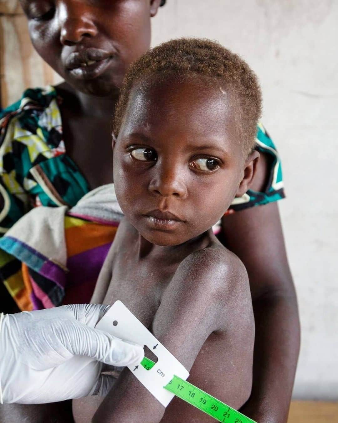 unicefさんのインスタグラム写真 - (unicefInstagram)「Five-year-old Havugimana is being screened for malnutrition at a UNICEF-supported health clinic in Kizimba, DR Congo. She’s one of more than 3 million children displaced by brutal violence in one of the world’s worst humanitarian crises. As the country grapples with measles, cholera and COVID-19, UNICEF is calling for conflict to stop now. #ChildrenUnderAttack © UNICEF/UN0390895/LeMoyne」2月19日 14時15分 - unicef