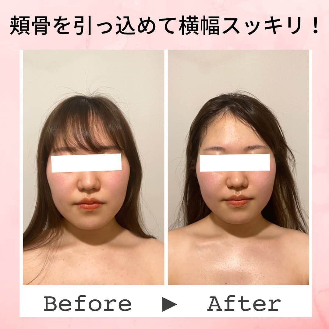 Eternal Total Beauty Salonのインスタグラム：「【ビフォーアフター】  こちらは1回での結果になります☺️  初めてのケアだったので、私的にはとてもやりがいがありました！笑  初めてのサロンにお選び頂きありがとうございます💕💕  ここから更に「整った小顔」✨ に仕上げていきます🤲 変化が楽しみですね😍  ＊＊＊＊＊＊＊＊＊＊＊＊＊＊  恵比寿駅西口徒歩4分♪ インディバエステ/小顔・痩身  営業時間　11:00〜21:00(19:00最終受付)  定休日　不定休  Tel 0364163830 お電話はつながり難い事が多いのでDMもしくはトップページの予約サイトから🙇‍♀️ 【@beautylian.111】  ＊＊＊＊＊＊＊＊＊＊＊＊＊＊  #インディバ  #インディバエステ  #インディバサロン  #インディバ 東京 #小顔東京 #小顔 #コルギ  #小顔矯正 #ビフォーアフター #ビフォーアフター写真  #セルライト除去  #免疫力を高める  #結果の出るサロン　 #顔の幅が狭くなる  #えらはり改善  #エラ張り解消  #左右差が整います  #むくみ防止  #浮腫み解消  #顔痩せ効果  #冷え性改善  #体質改善 #高周波 #美と健康 #リフトアップ #エニシーグローパック正規取扱店」