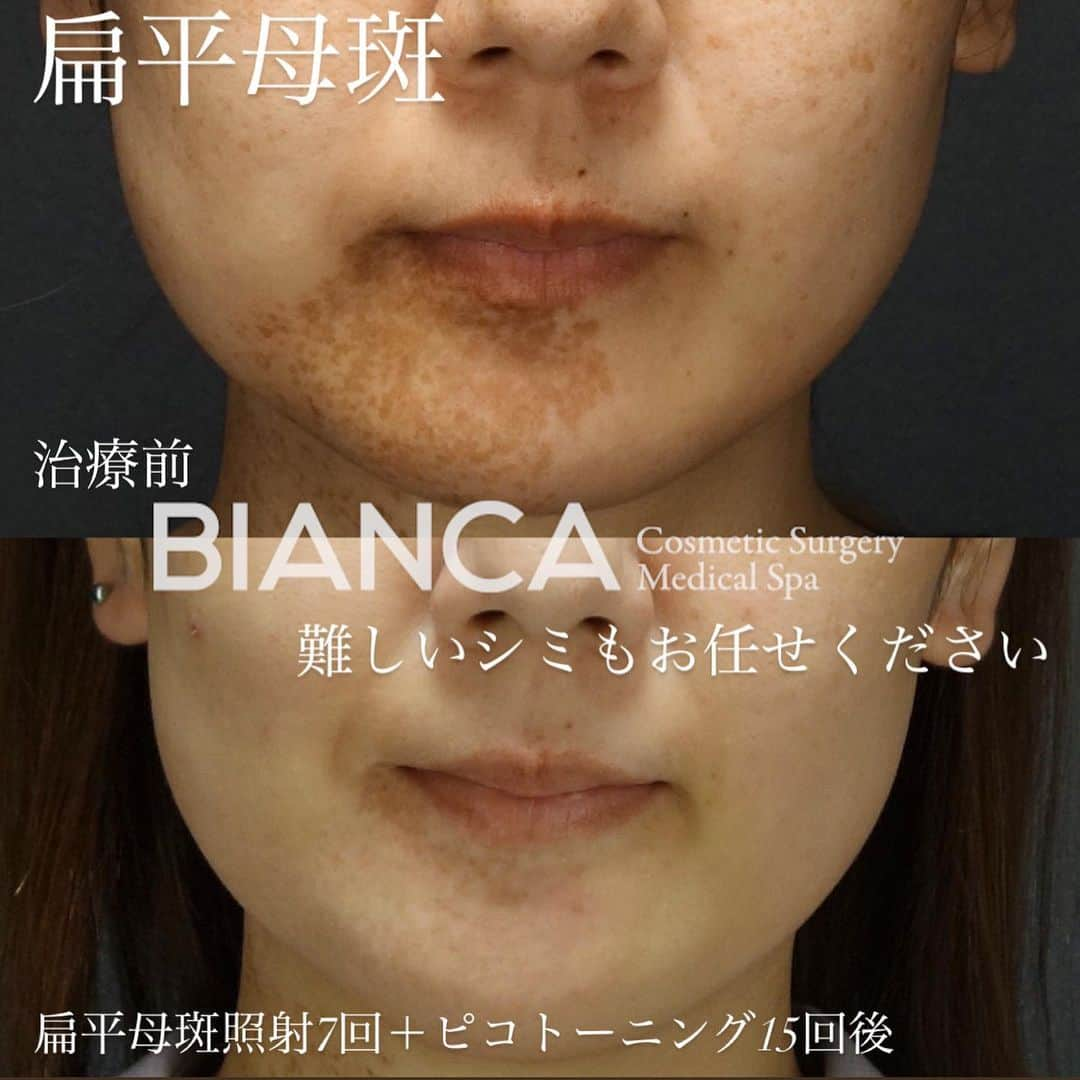 辻沢由有（BIANCA CLNIC 表参道院 院長）さんのインスタグラム写真 - (辻沢由有（BIANCA CLNIC 表参道院 院長）Instagram)「#dryuu肌﻿ ▶︎swipeで文字なし症例写真▶︎﻿ ﻿ 境界明瞭で剛毛を伴わない﻿ 色調が均一なシミ…扁平母斑。﻿ ﻿ 他院で治療を断られても﻿ あきらめないでください。﻿ ﻿ レーザー治療は正しい知識と技術﻿ そして症例数がものを言います。﻿ ﻿ 上 治療前﻿ 下 扁平母斑照射7回＋ピコトーニング15回後﻿ ﻿ 1人で悩んでいる時間はもったいないです❗️😵⭐﻿ 気になる方は是非カウンセリングにお越しください☺️️﻿ ﻿ 💵扁平母斑照射 20,000円〜/回（範囲による）﻿ 😷DT: シミの黒浮き1週間程度﻿ ⚠️リスク: 色素脱失・色素沈着・水泡形成など﻿ 💴ピコトーニング 14,800円/回﻿ ﻿ 🉐モニター大募集中♡﻿ ⚠️ご予約の際は﻿ 『Dr Yuu（辻沢）のインスタ見た』の一言をお願いします👩‍⚕️✨﻿ ﻿ 📍BIANCA CLINIC﻿ ✔︎銀座院﻿ 03-6263-2690 ﻿ 東京都中央区銀座1-5-6 銀座レンガ通り福神ビル 4F﻿ ﻿ ✔︎表参道院﻿ 03-6433-5994﻿ 東京都港区南青山5-11-10  南青山511ビル 2F﻿ 診療時間 10:00～19:00﻿ ﻿ #plasticsurgery #cosmeticsurgery  #美容外科 #美容皮膚科 #美容整形 #プチ整形 #美肌 #美魔女 #美容 #アンチエイジング  #picosure #ピコシュア #ピコトーニング #ピコフラクショナル #ビアンカクリニック #dryuu #シミ取り #そばかす #シミ治療 #dryuu美容 #ソバカス #スキンケア #美白 #biancaclinic #ビアンカクリニック #レーザートーニング #モニター募集  #dryuu肌#扁平母斑#アザ」2月22日 13時33分 - i_am_yuu__